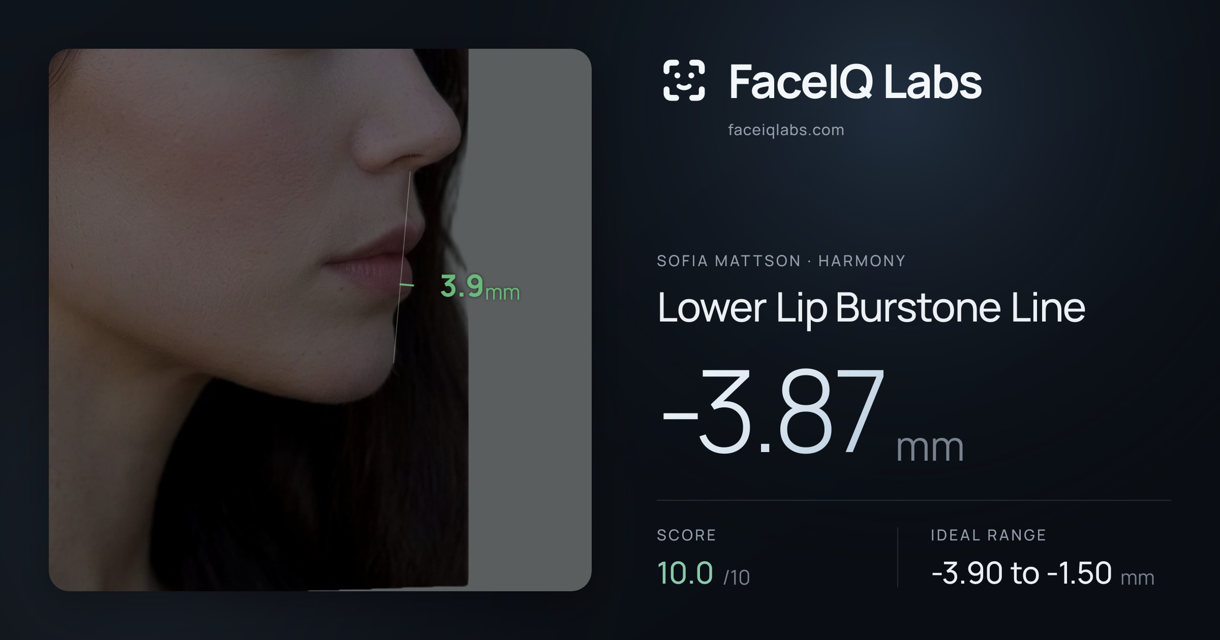 Sofia Mattson Lower Lip Burstone Line: -3.87mm, drawn on the photo