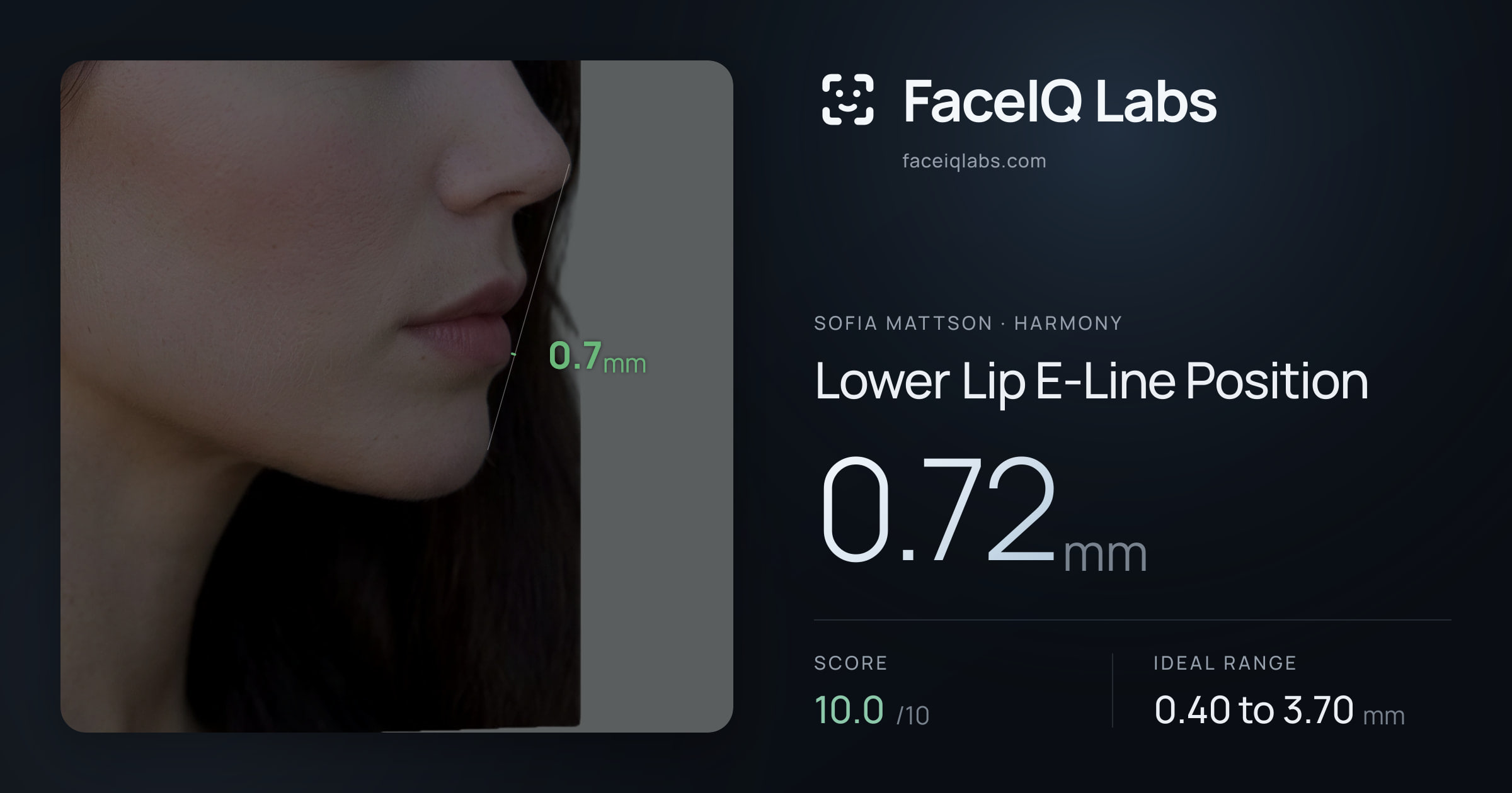 Sofia Mattson Lower Lip E-Line Position: 0.72mm, drawn on the photo