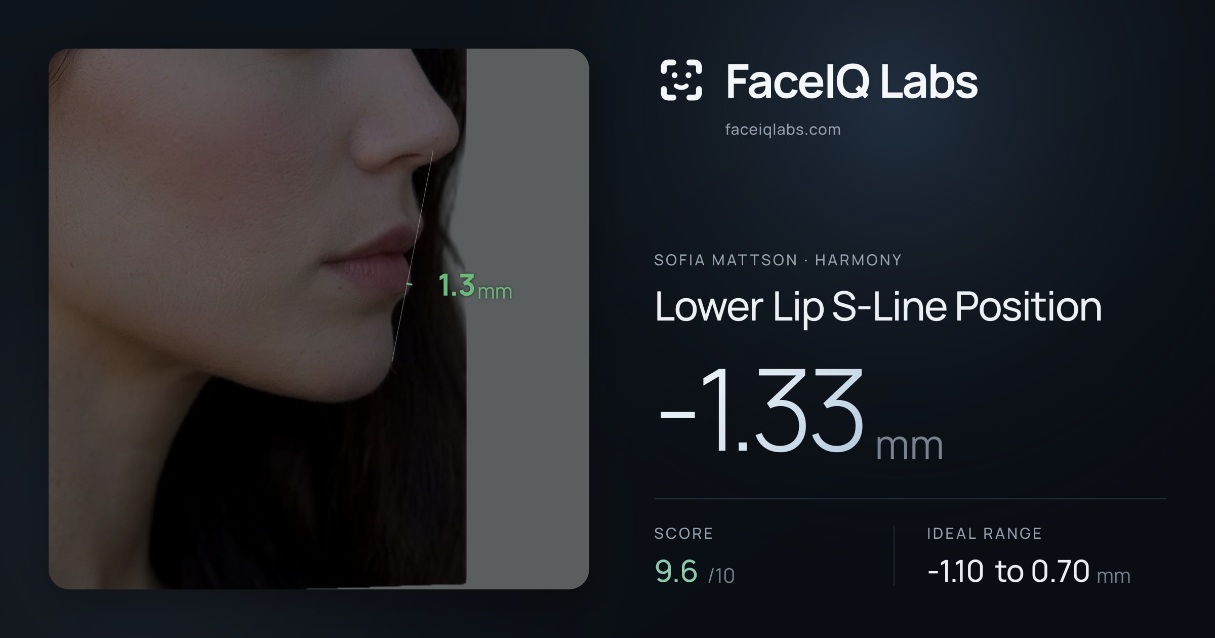 Sofia Mattson Lower Lip S-Line Position: -1.33mm, drawn on the photo