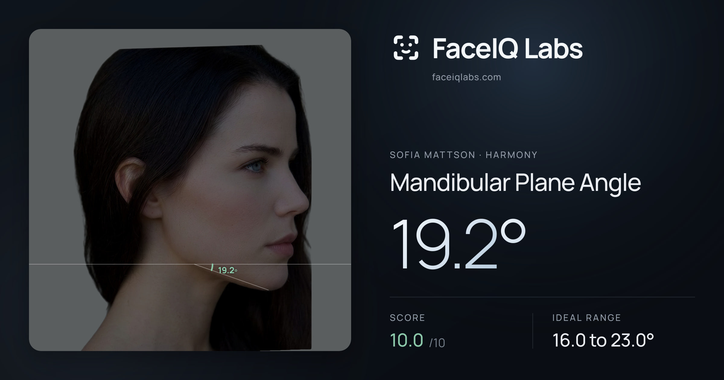 Sofia Mattson Mandibular Plane Angle: 19.2°, drawn on the photo
