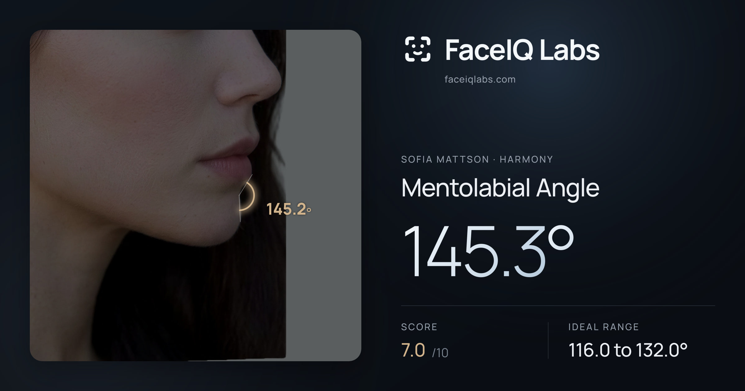 Sofia Mattson Mentolabial Angle: 145.3°, drawn on the photo