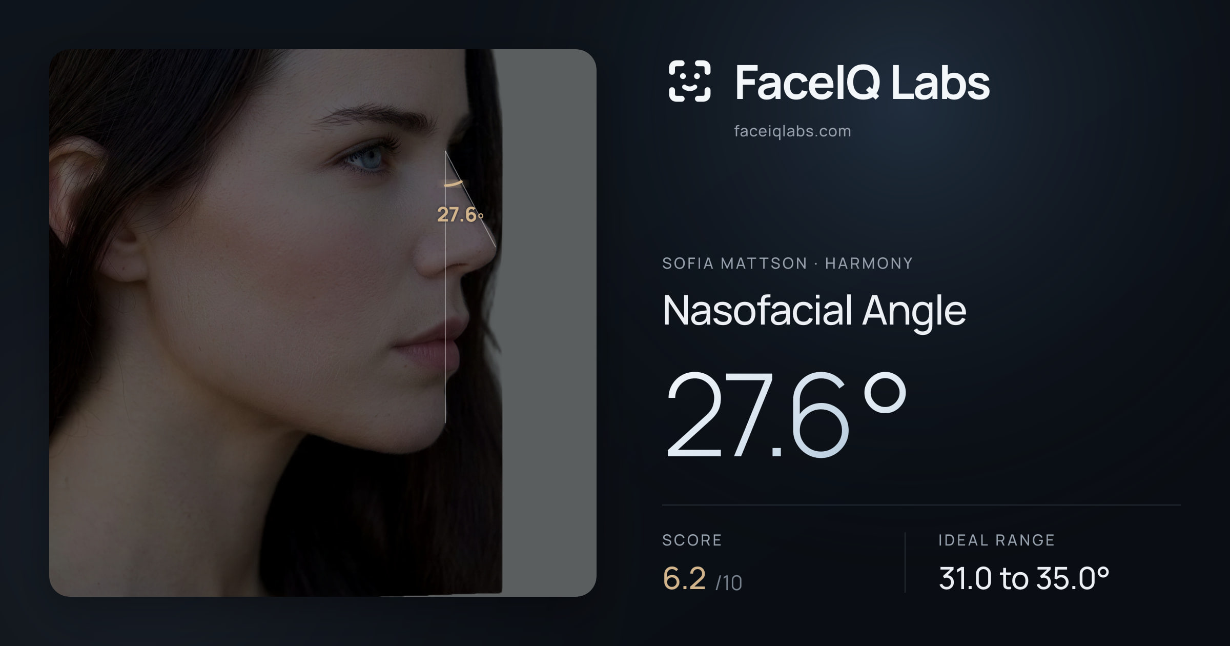 Sofia Mattson Nasofacial Angle: 27.6°, drawn on the photo