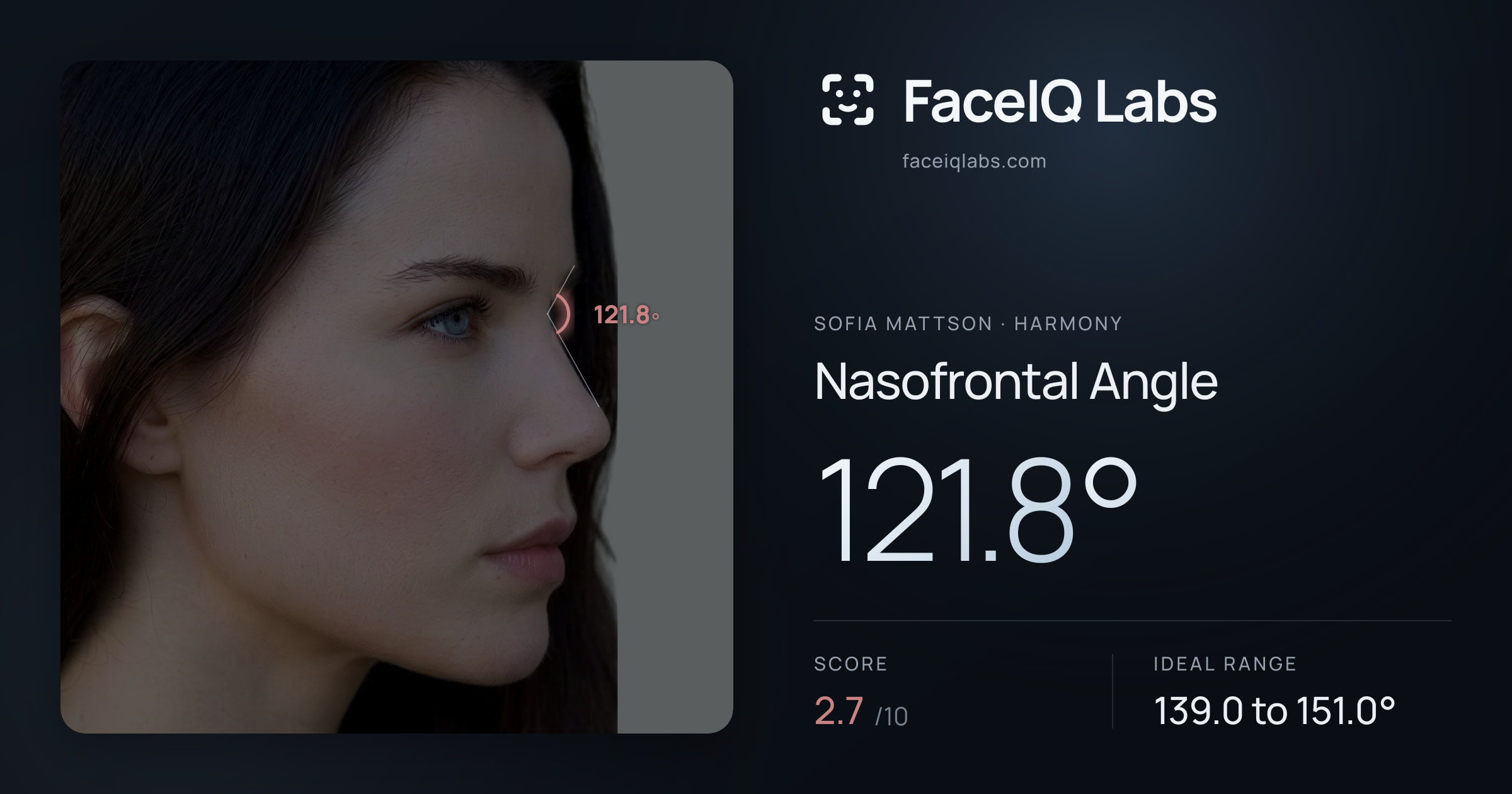 Sofia Mattson Nasofrontal Angle: 121.8°, drawn on the photo