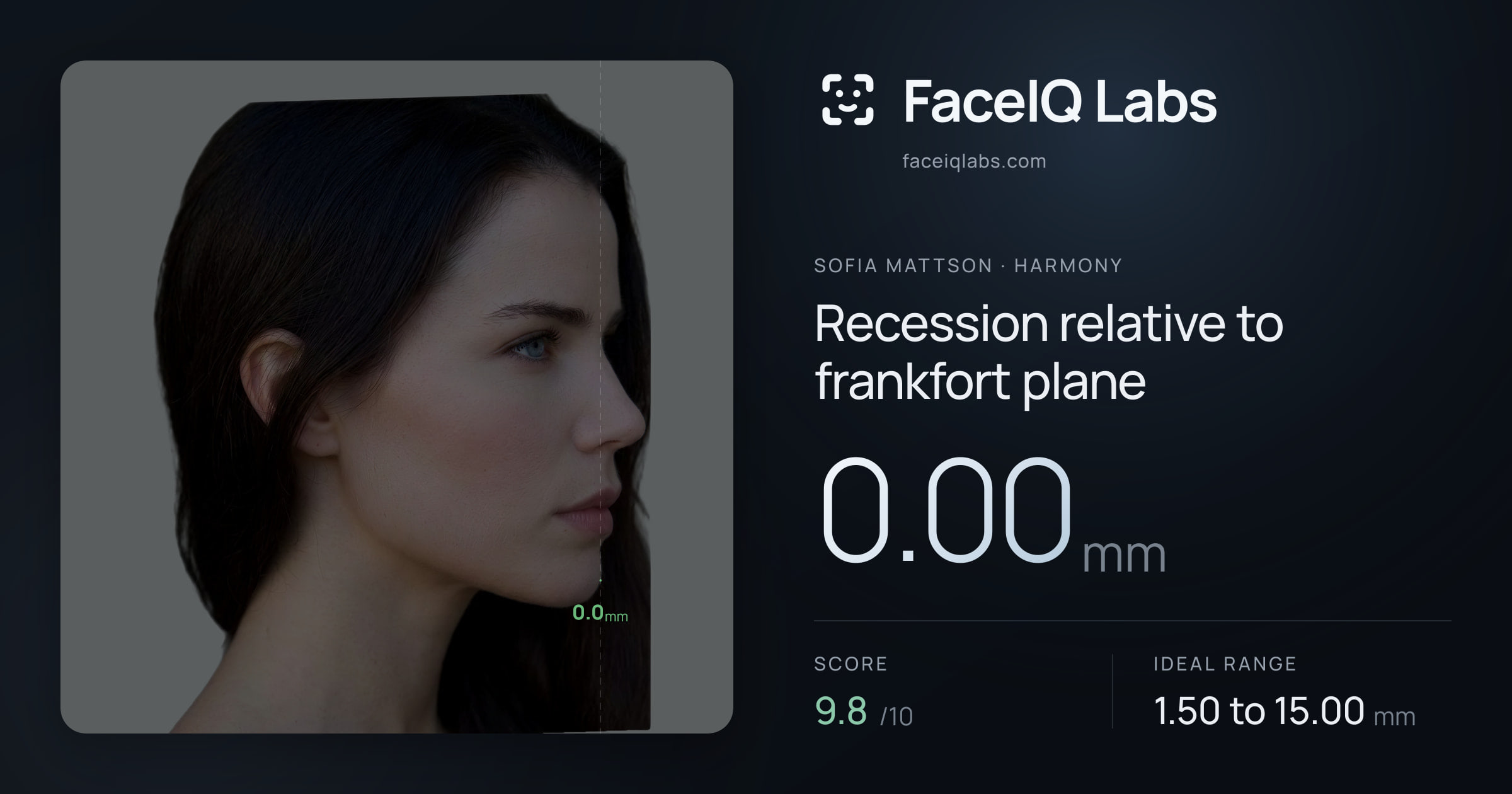 Sofia Mattson Recession relative to frankfort plane: 0.00mm, drawn on the photo
