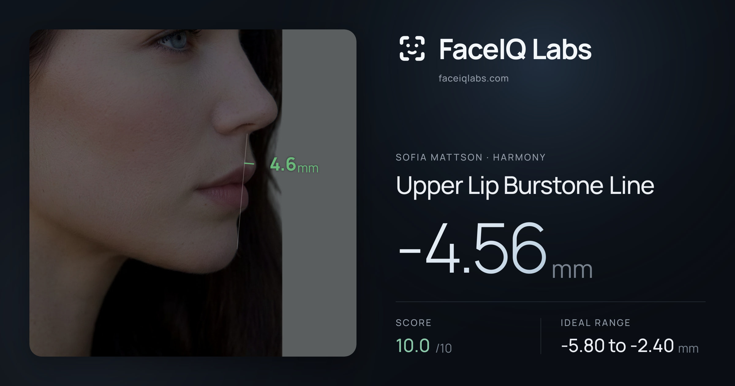 Sofia Mattson Upper Lip Burstone Line: -4.56mm, drawn on the photo