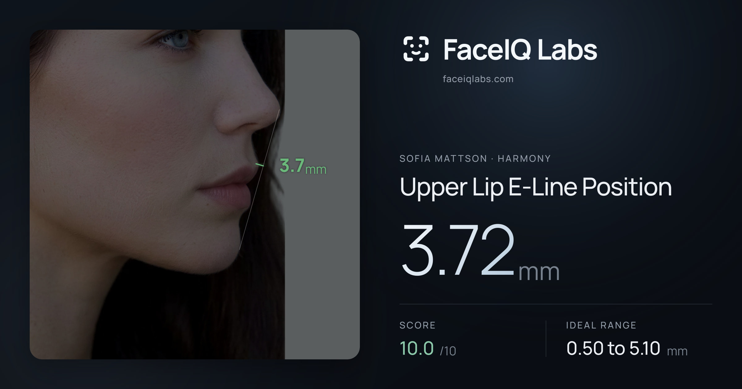 Sofia Mattson Upper Lip E-Line Position: 3.72mm, drawn on the photo