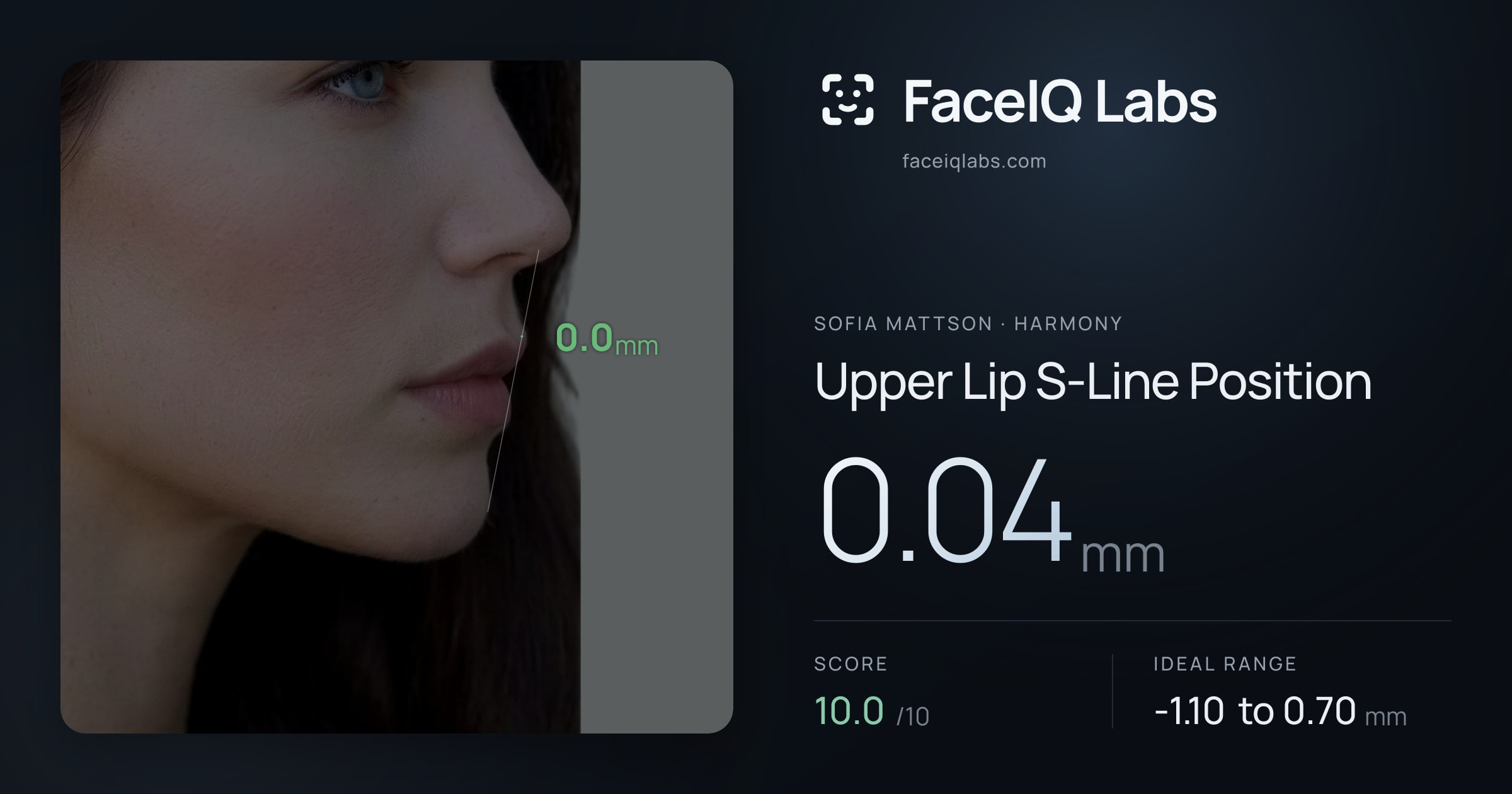 Sofia Mattson Upper Lip S-Line Position: 0.04mm, drawn on the photo