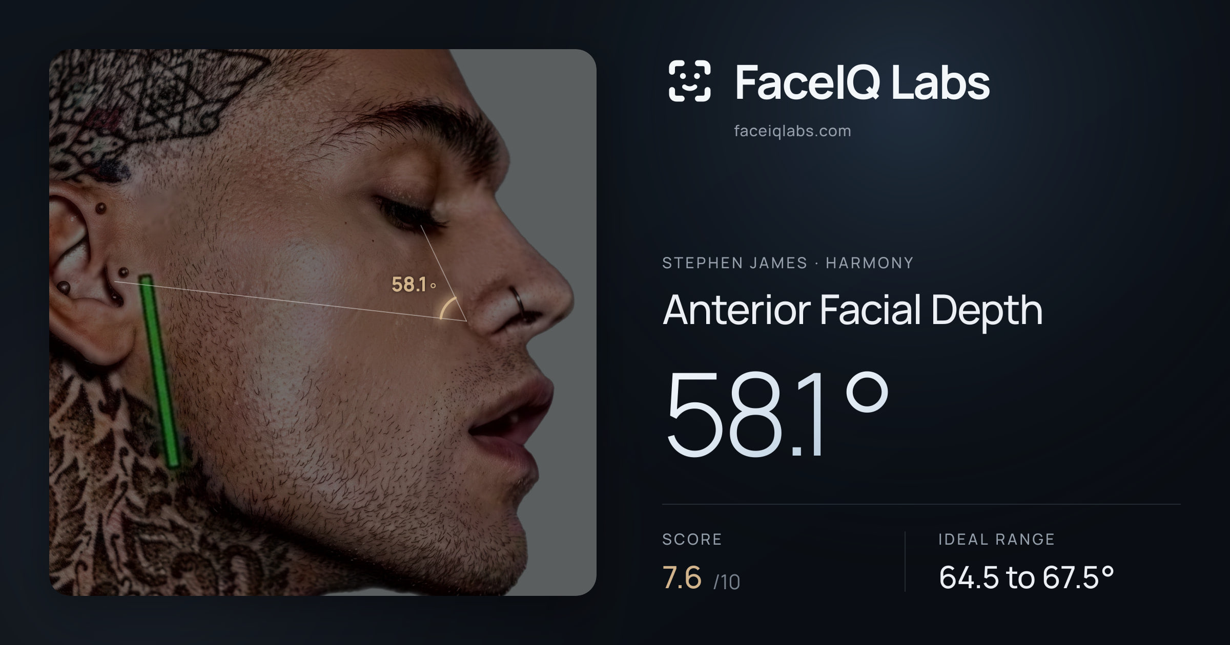 Stephen James Anterior Facial Depth: 58.1°, drawn on the photo