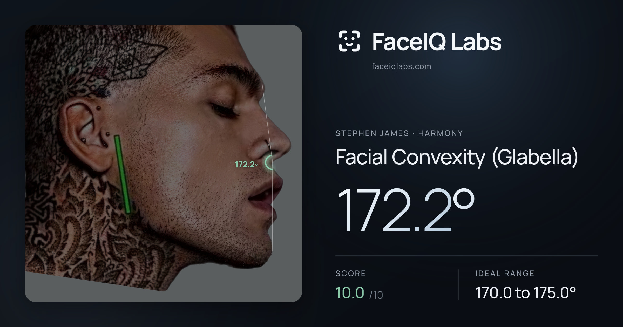 Stephen James Facial Convexity (Glabella): 172.2°, drawn on the photo