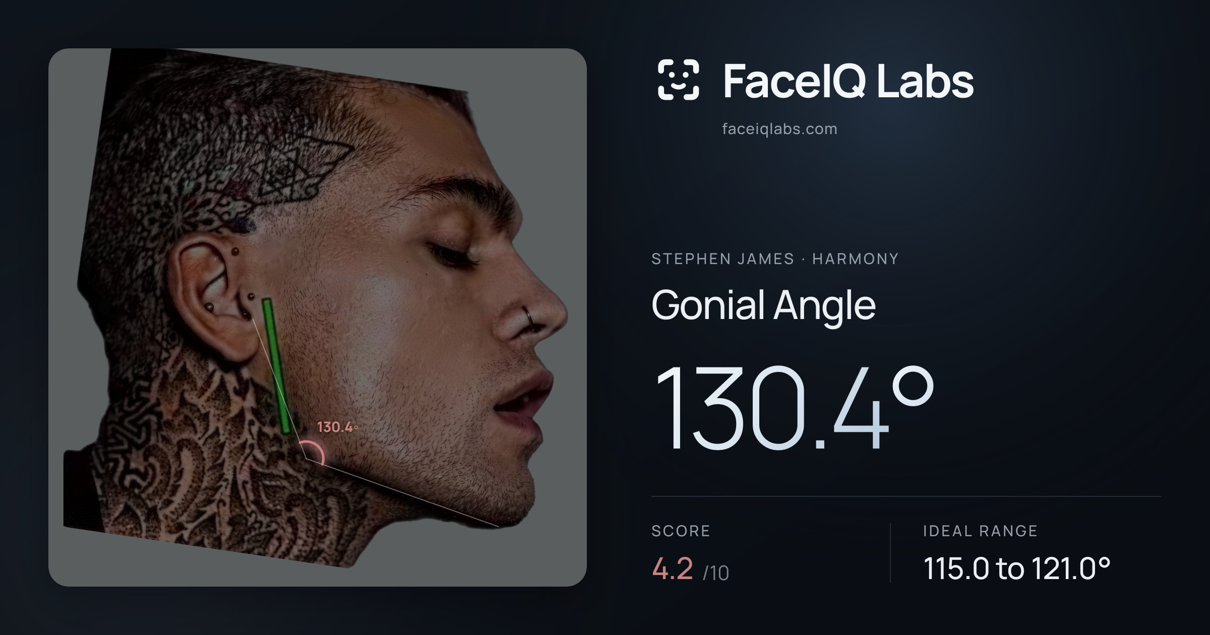 Stephen James Gonial Angle: 130.4°, drawn on the photo