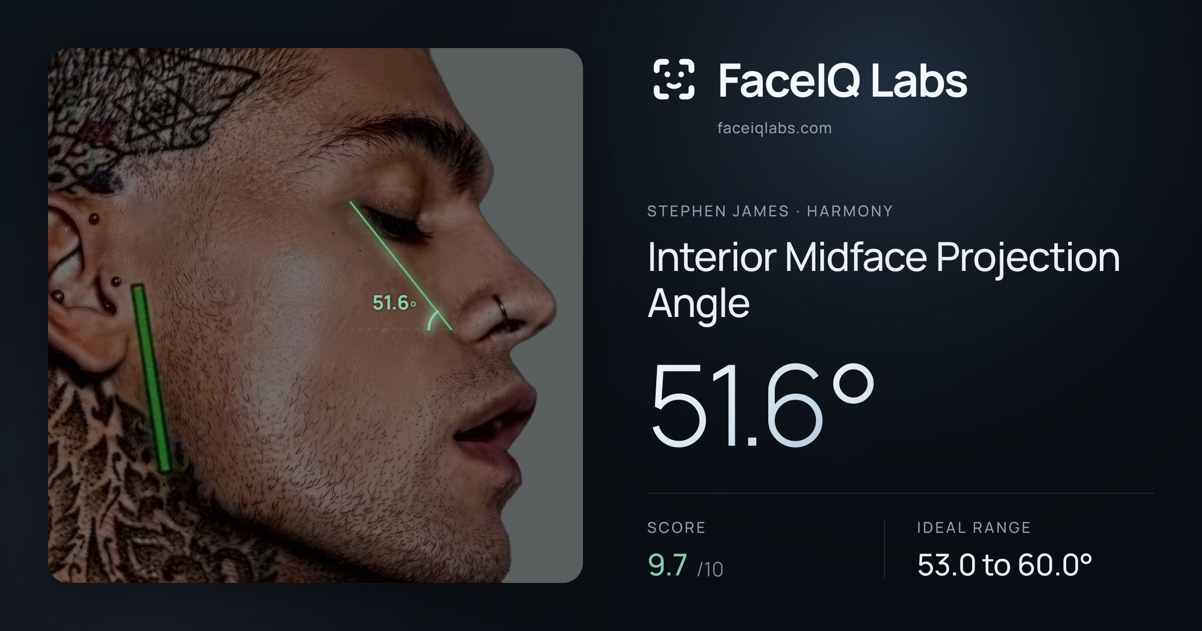 Stephen James Interior Midface Projection Angle: 51.6°, drawn on the photo