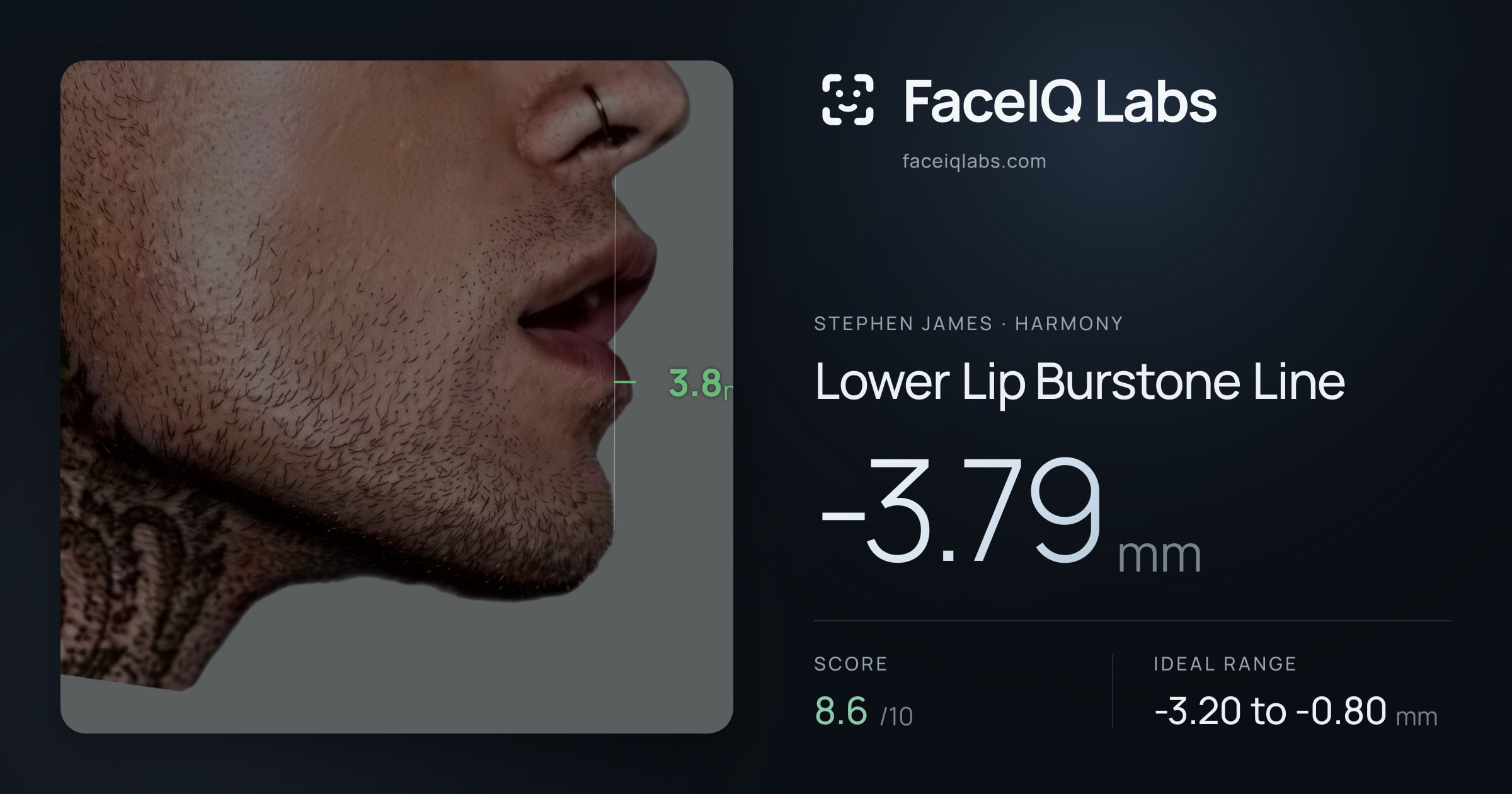 Stephen James Lower Lip Burstone Line: -3.79mm, drawn on the photo