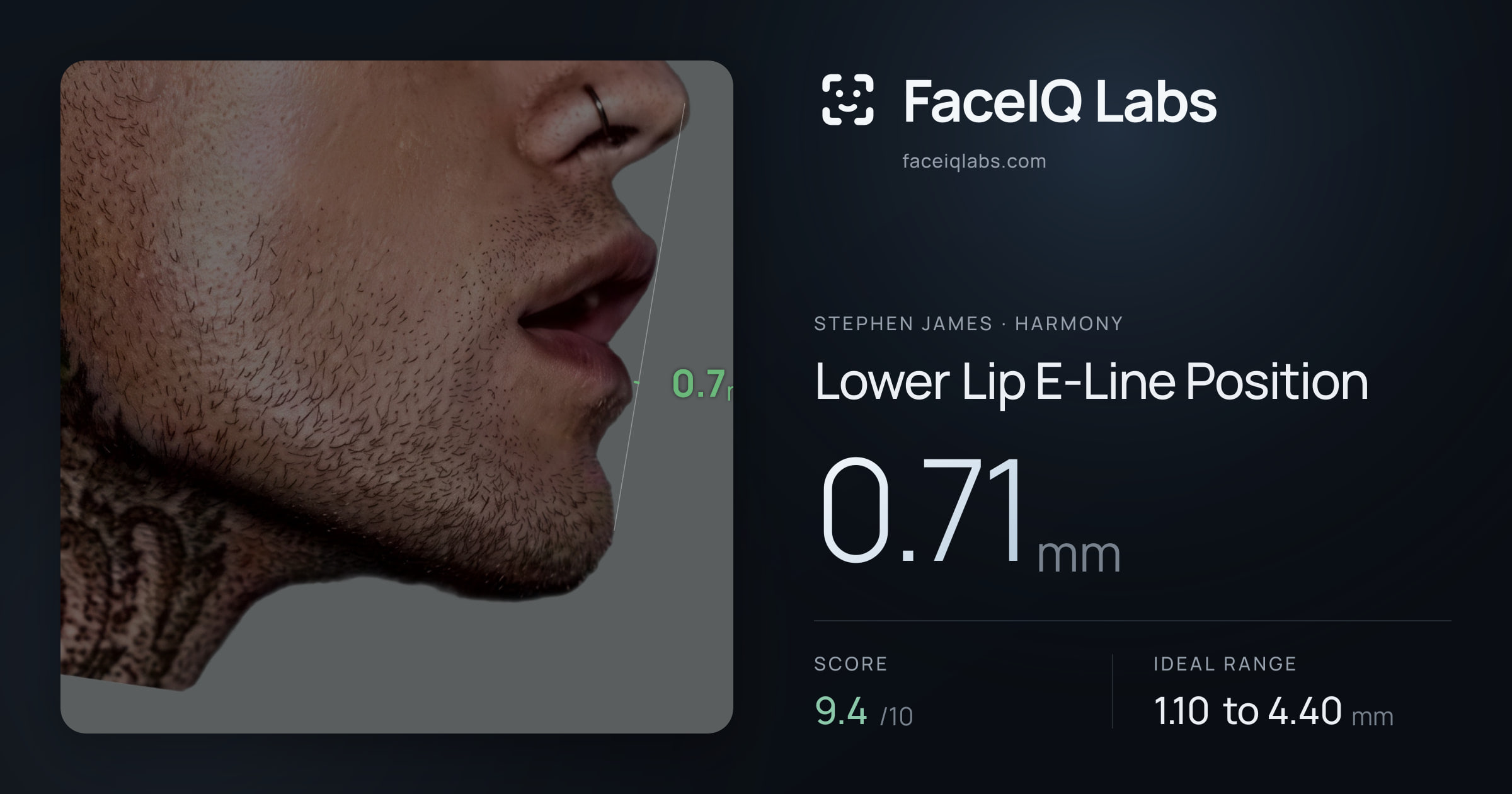 Stephen James Lower Lip E-Line Position: 0.71mm, drawn on the photo