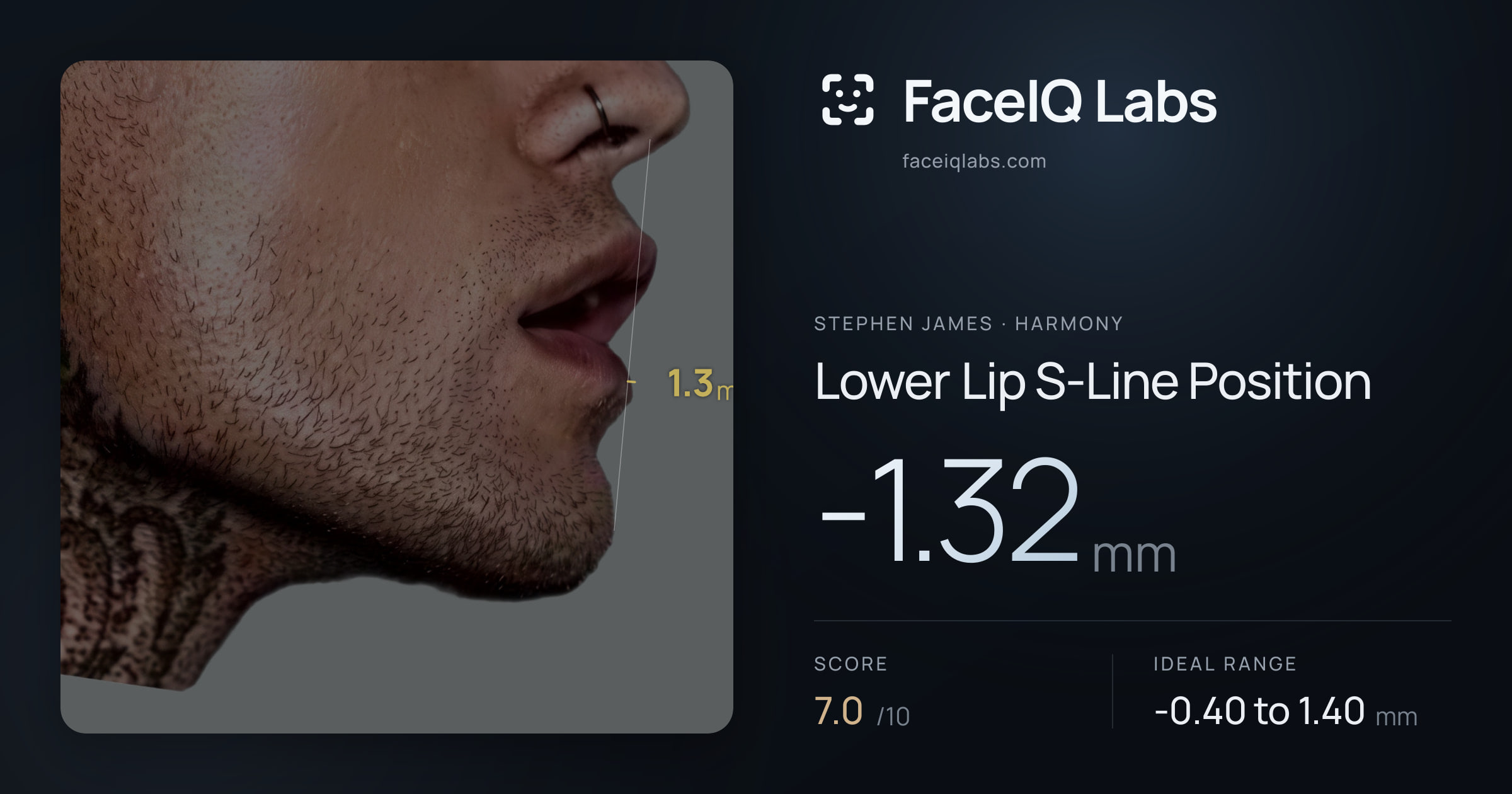 Stephen James Lower Lip S-Line Position: -1.32mm, drawn on the photo