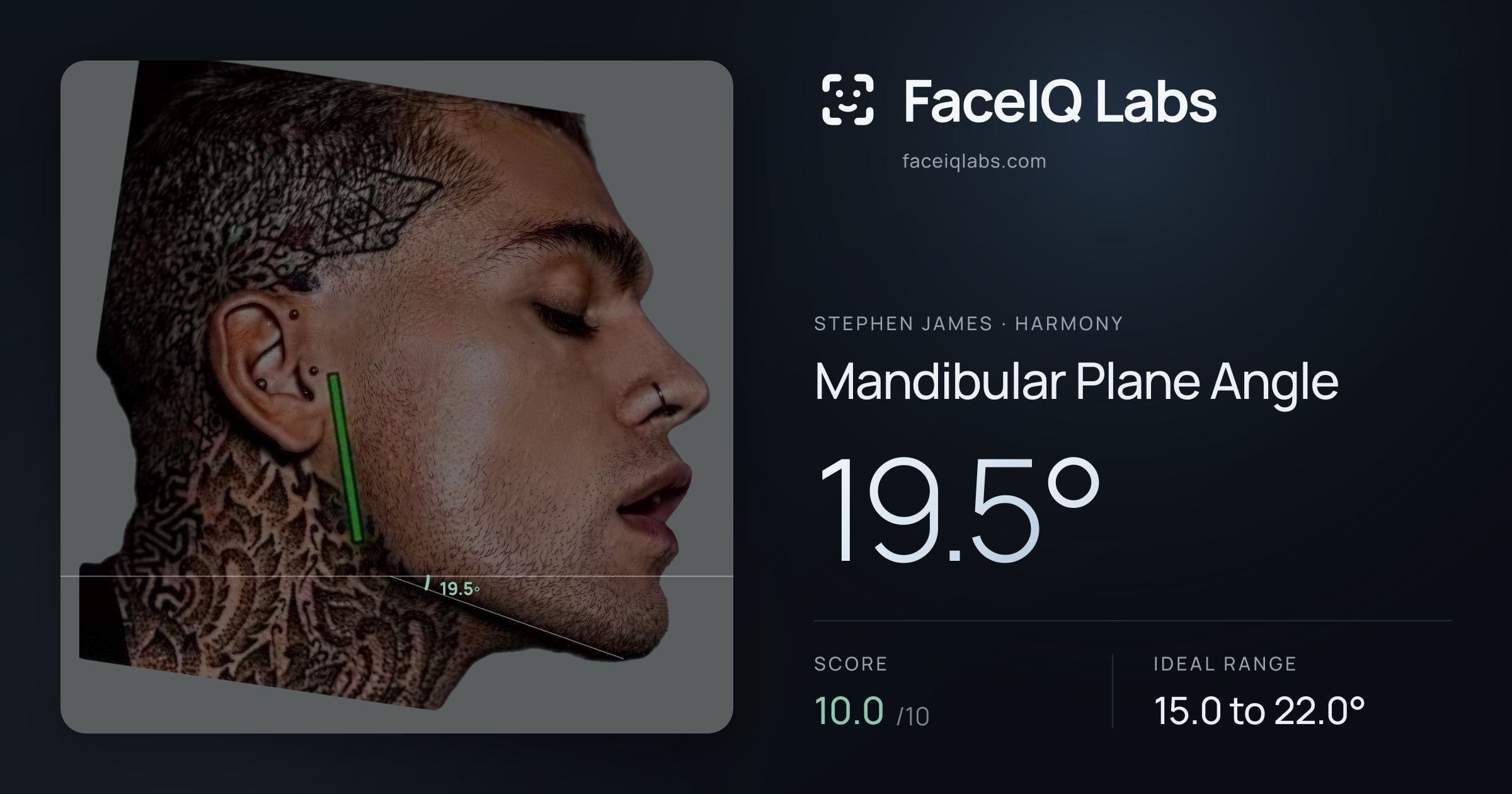 Stephen James Mandibular Plane Angle: 19.5°, drawn on the photo