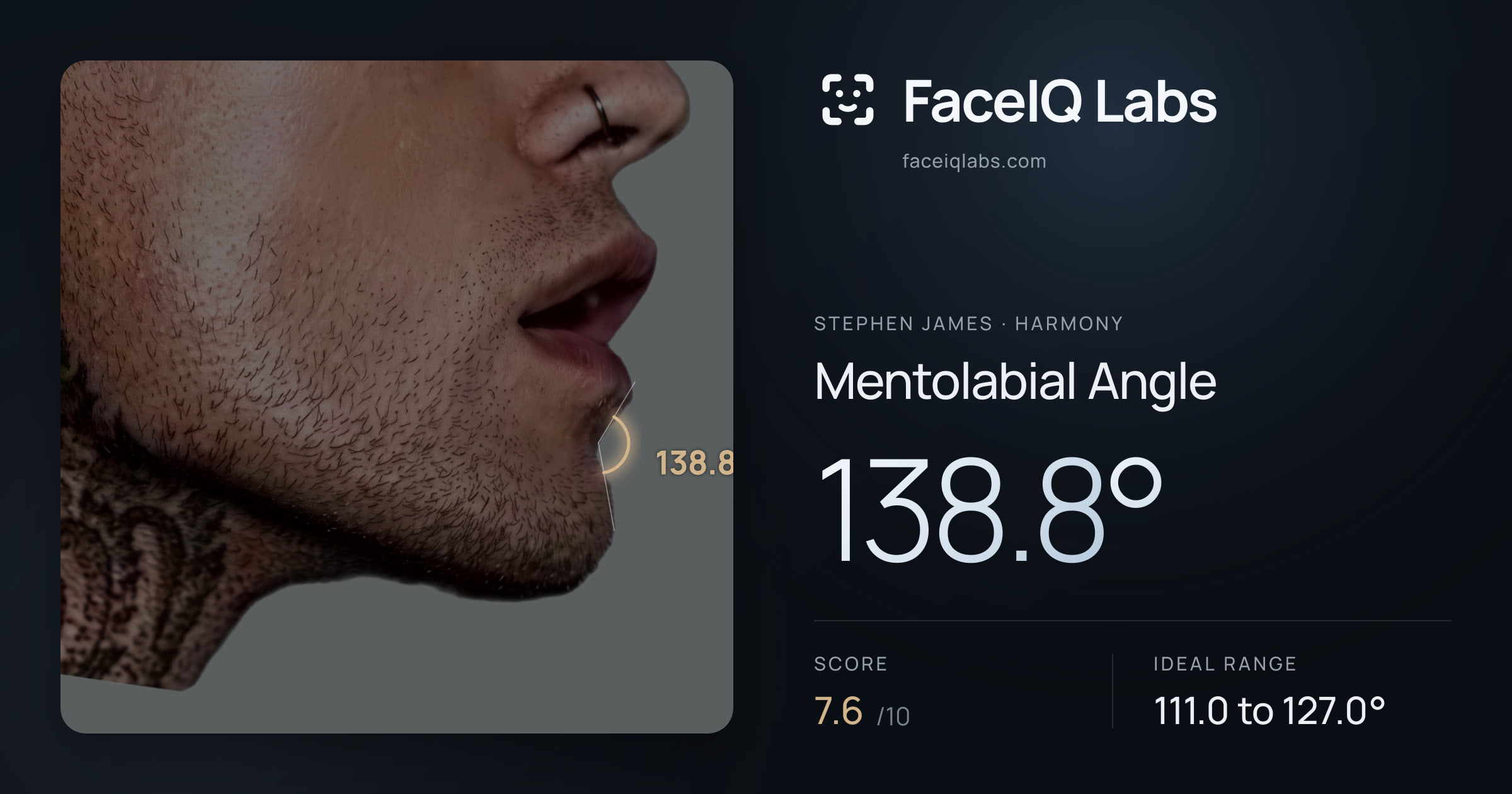 Stephen James Mentolabial Angle: 138.8°, drawn on the photo