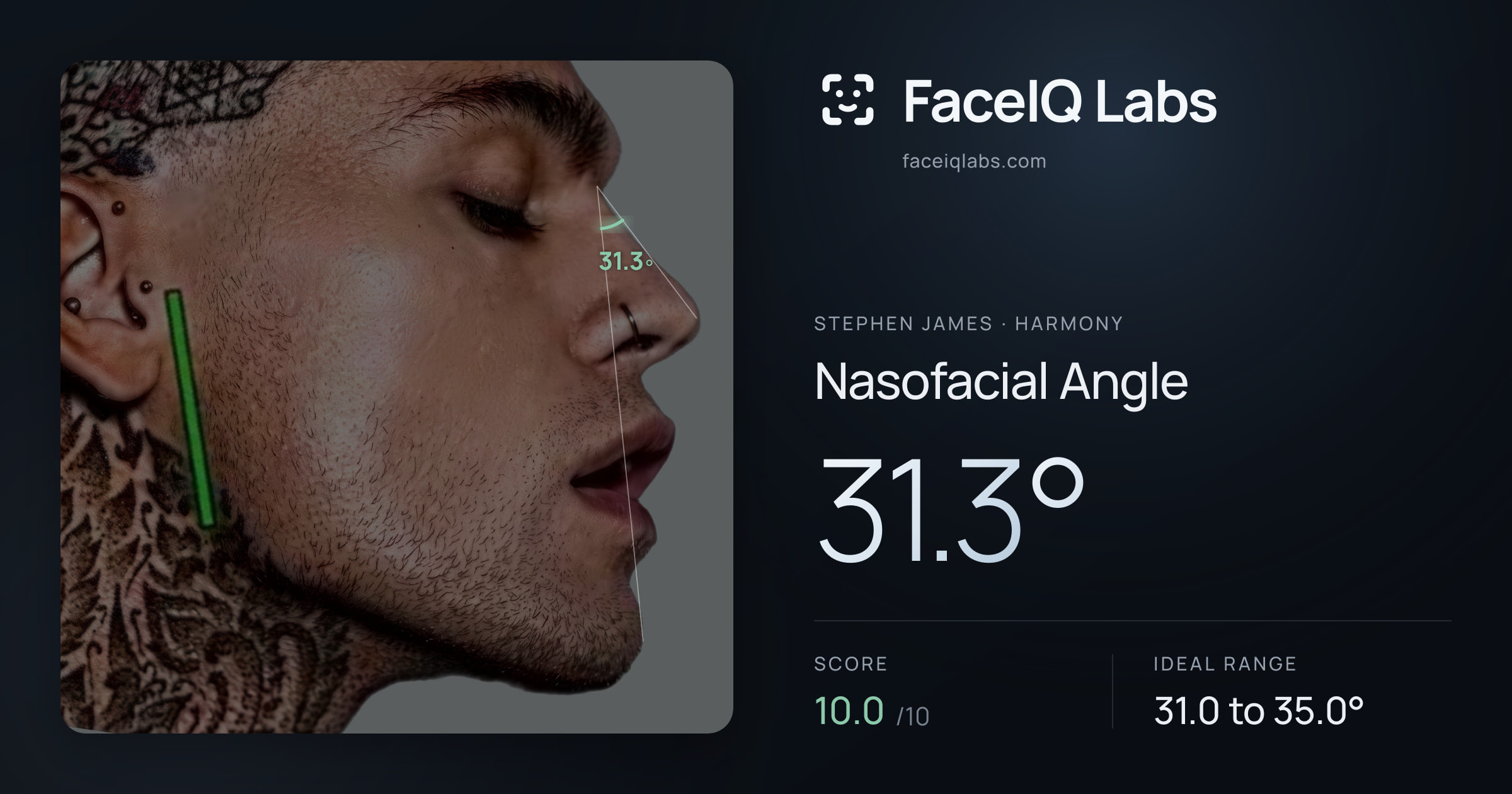 Stephen James Nasofacial Angle: 31.3°, drawn on the photo