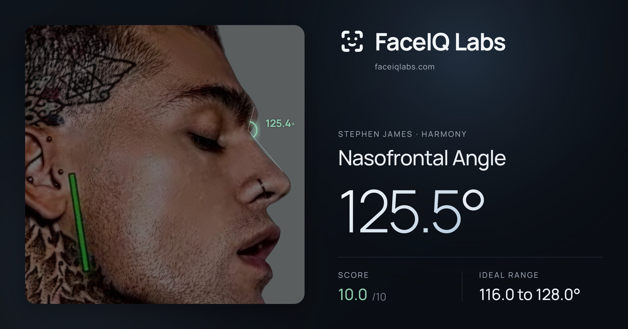 Stephen James Nasofrontal Angle: 125.5°, drawn on the photo