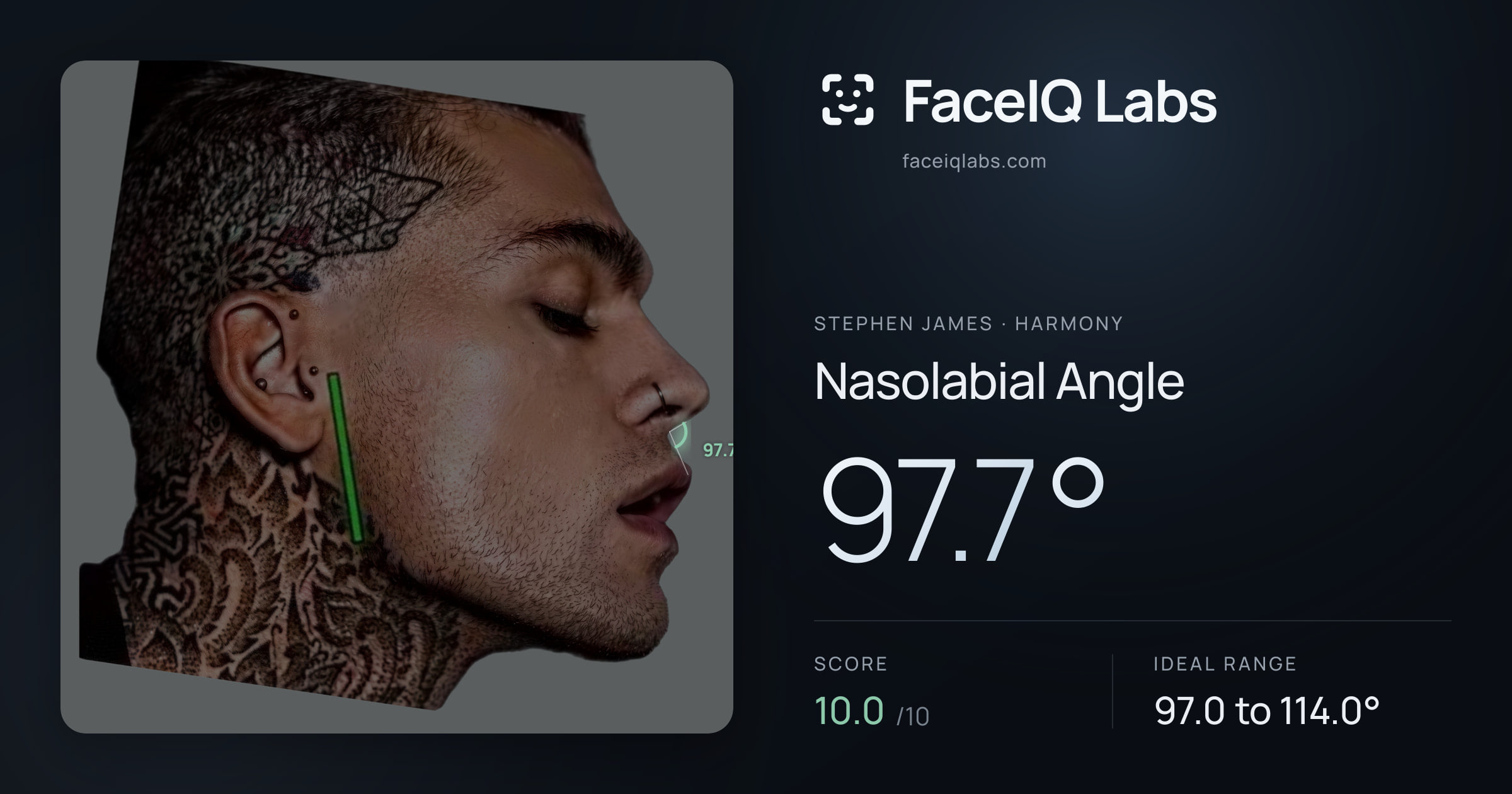 Stephen James Nasolabial Angle: 97.7°, drawn on the photo