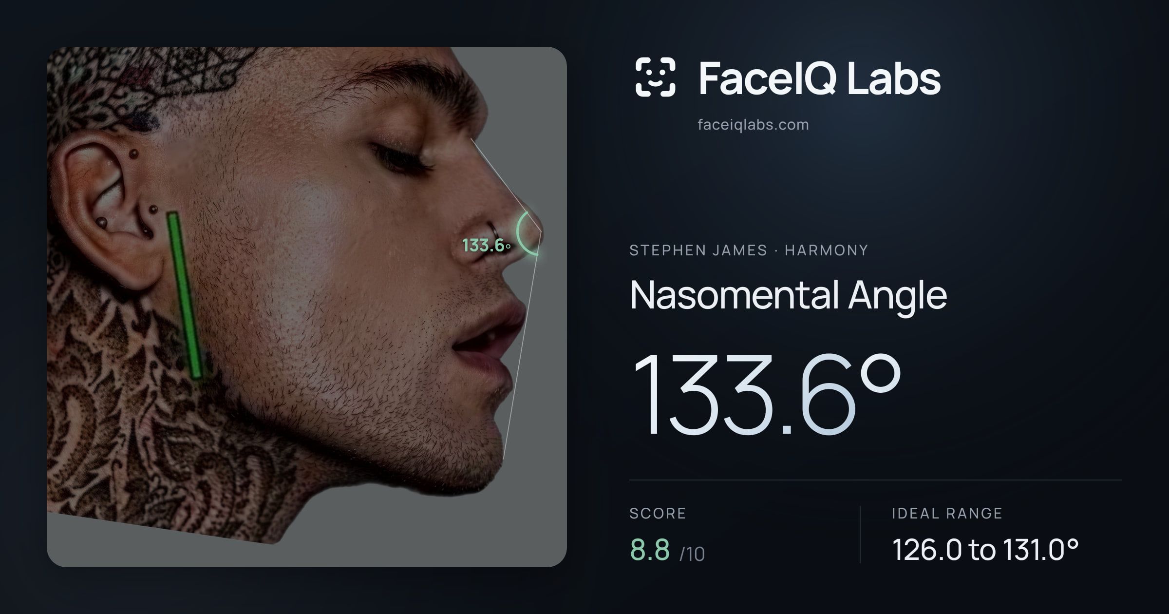 Stephen James Nasomental Angle: 133.6°, drawn on the photo