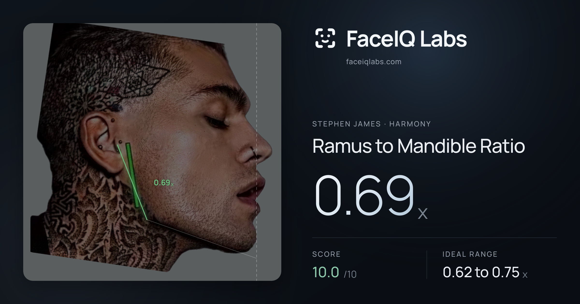 Stephen James Ramus to Mandible Ratio: 0.69x, drawn on the photo