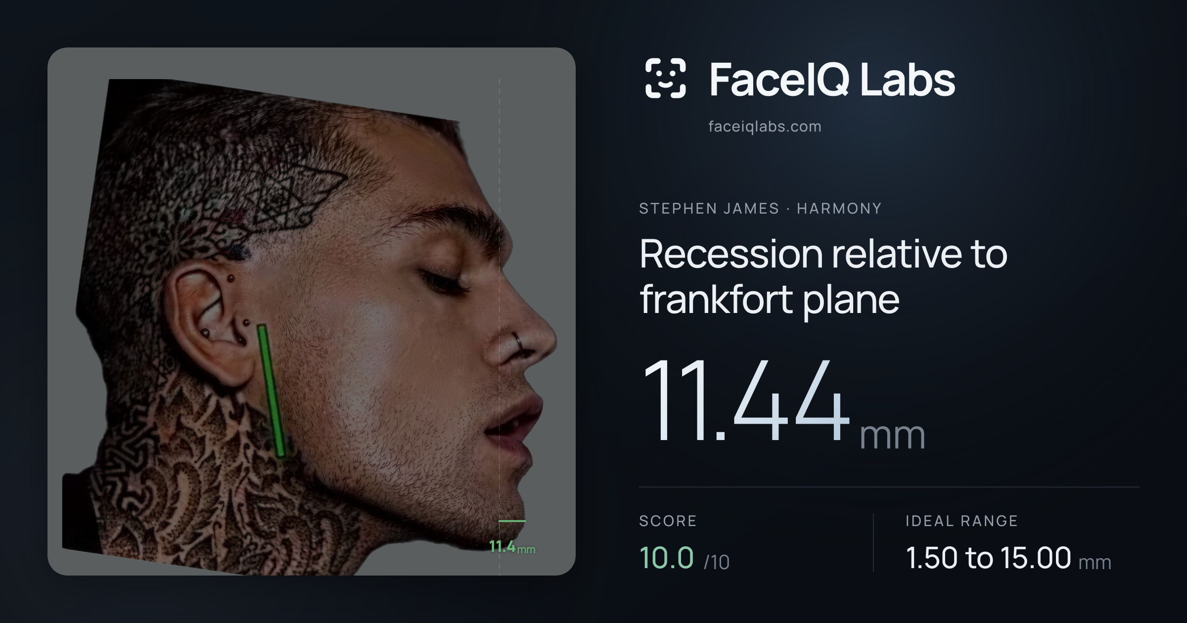 Stephen James Recession relative to frankfort plane: 11.44mm, drawn on the photo
