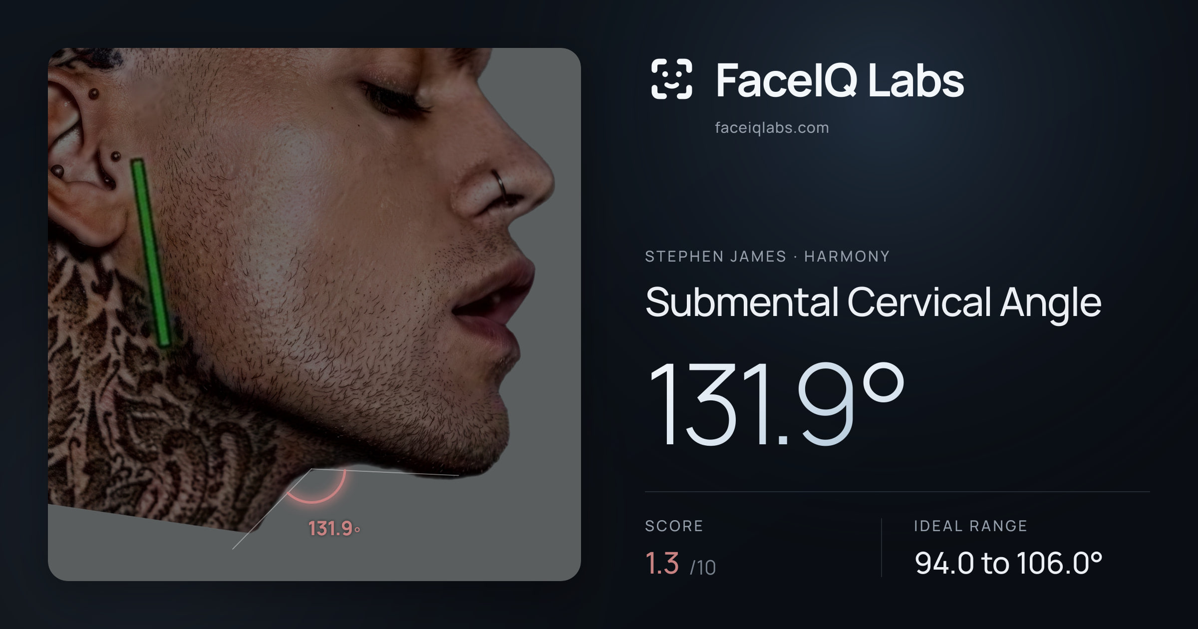 Stephen James Submental Cervical Angle: 131.9°, drawn on the photo