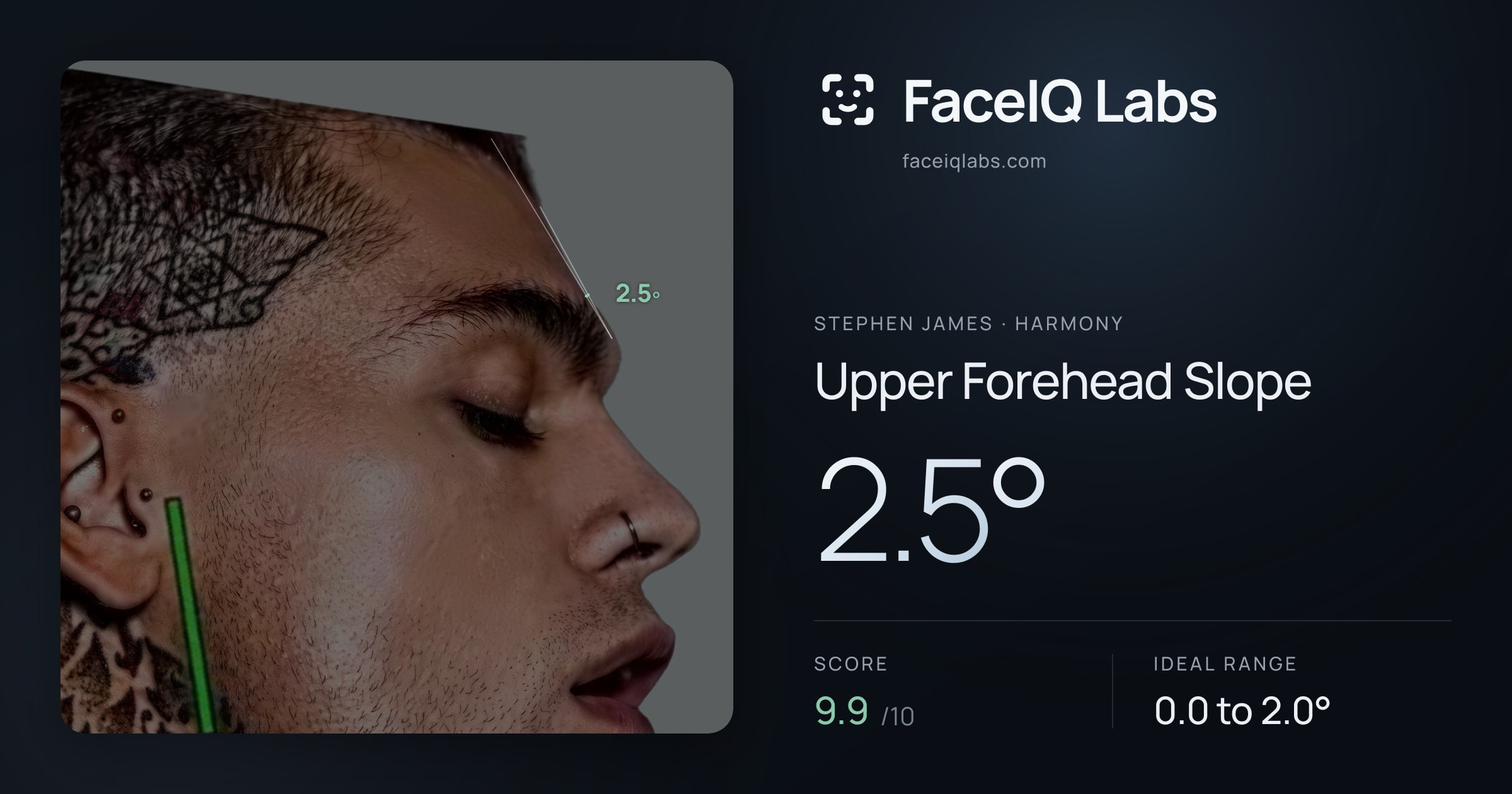 Stephen James Upper Forehead Slope: 2.5°, drawn on the photo