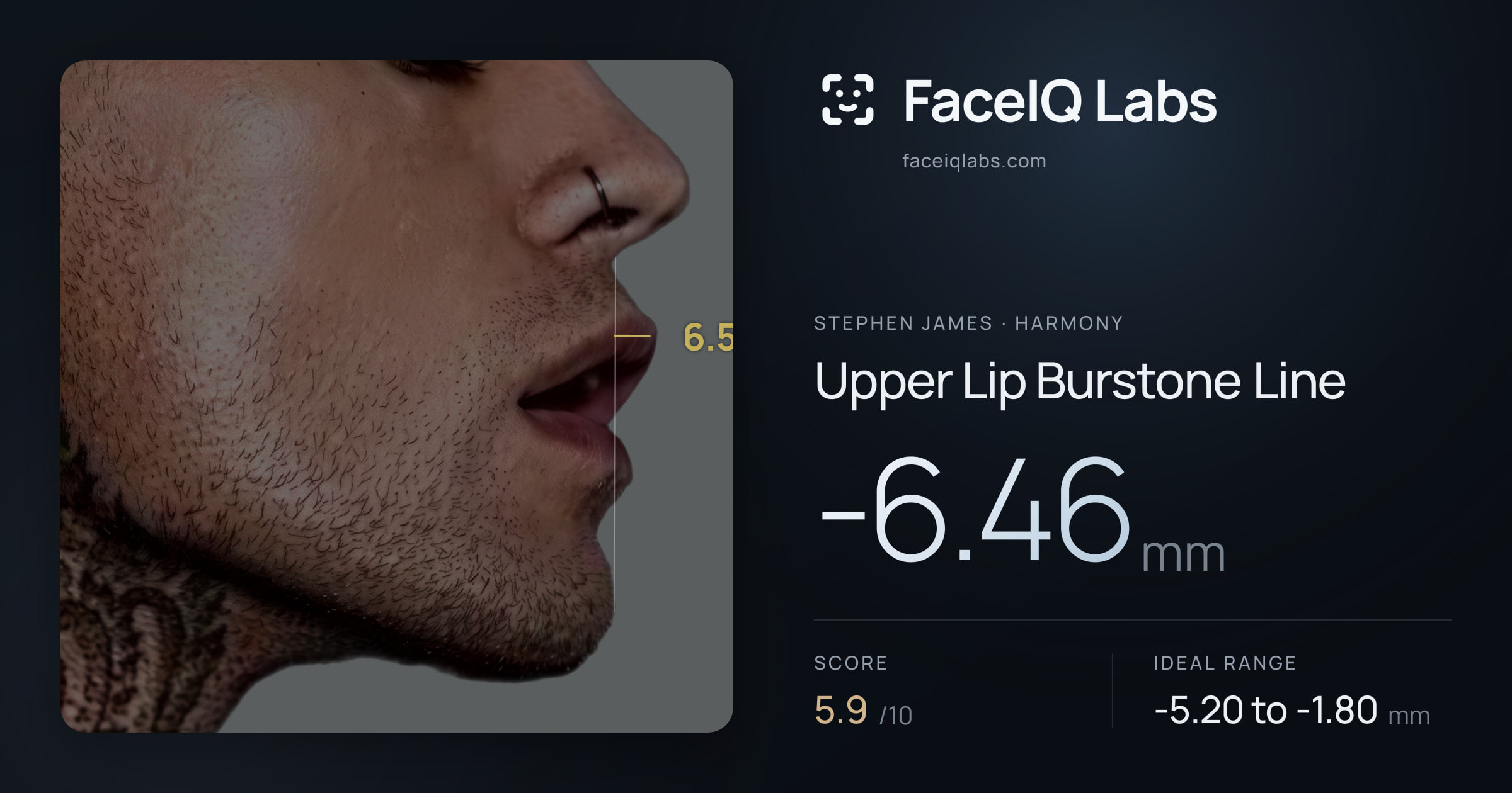 Stephen James Upper Lip Burstone Line: -6.46mm, drawn on the photo