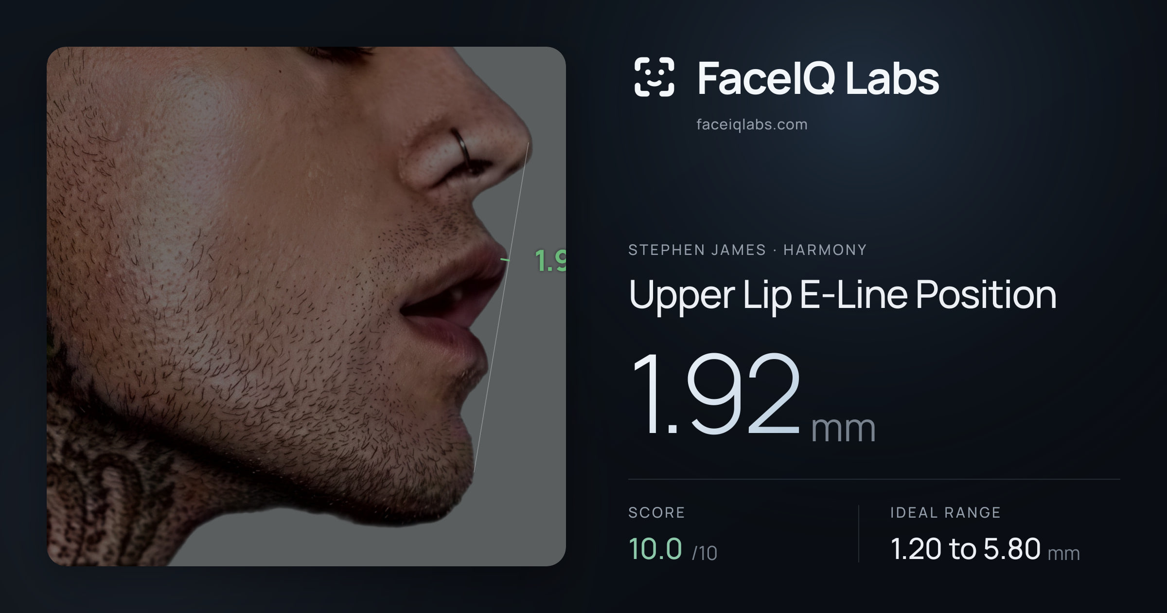 Stephen James Upper Lip E-Line Position: 1.92mm, drawn on the photo