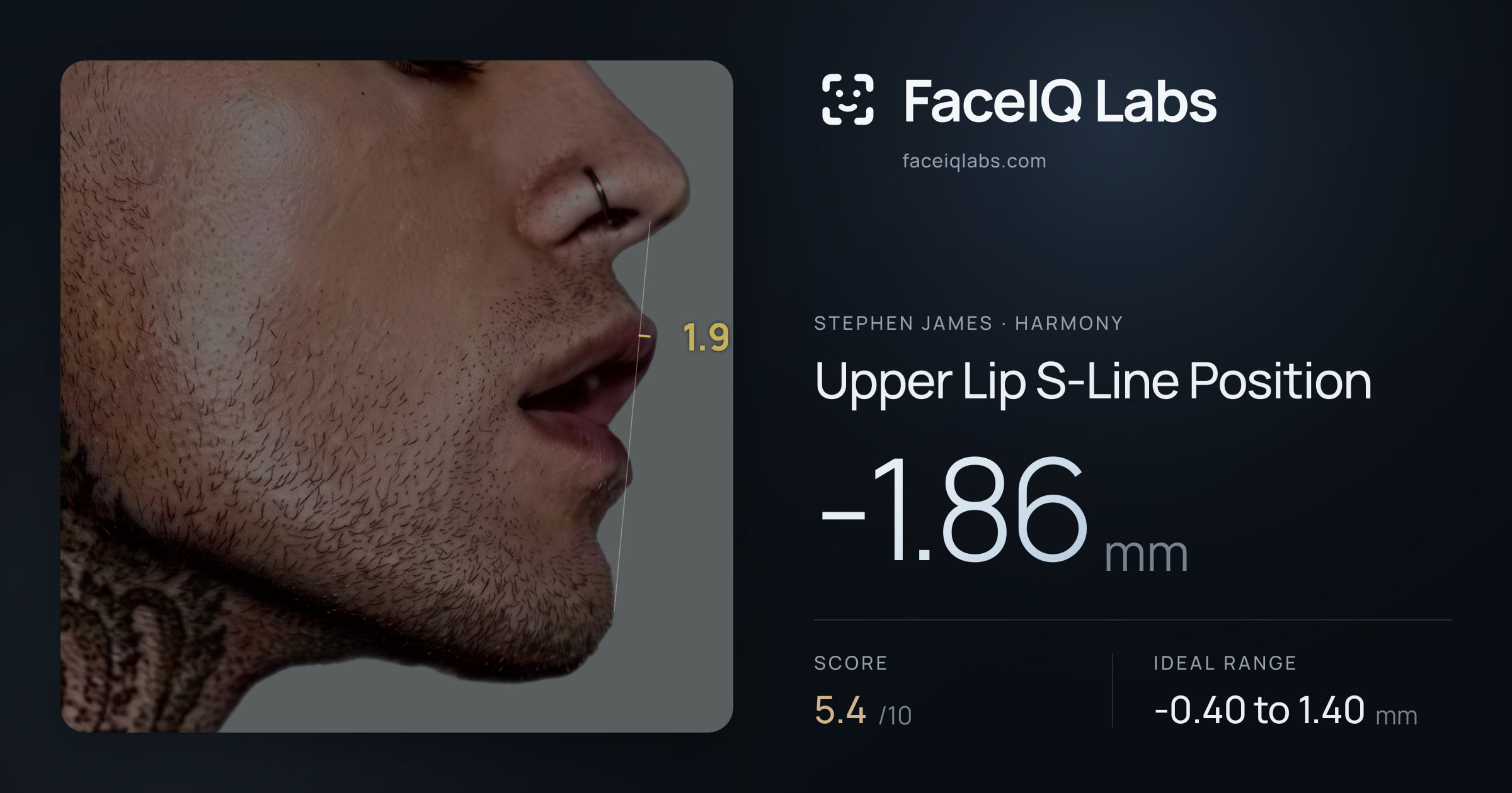 Stephen James Upper Lip S-Line Position: -1.86mm, drawn on the photo