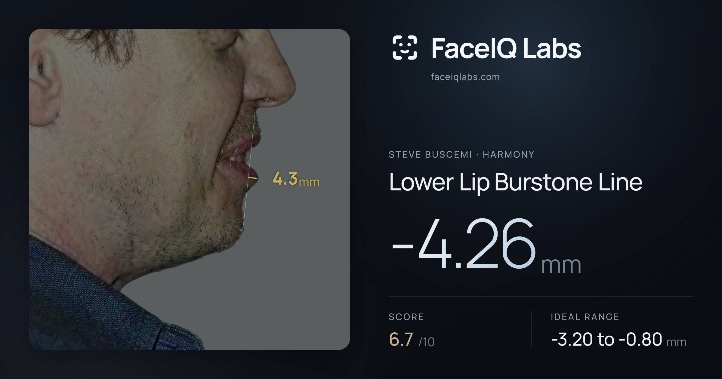 Steve Buscemi Lower Lip Burstone Line: -4.26mm, drawn on the photo