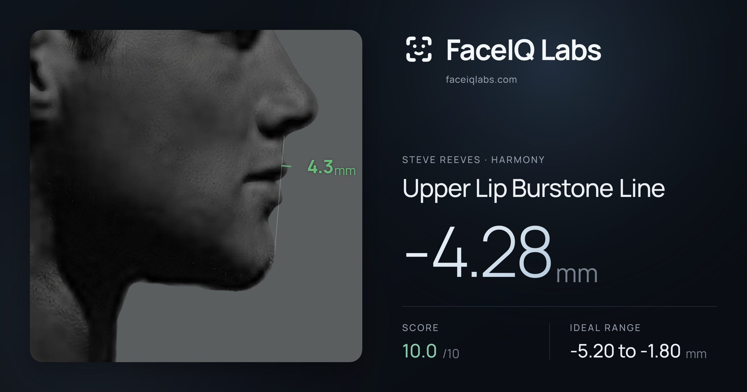 Steve Reeves Upper Lip Burstone Line: -4.28mm, drawn on the photo