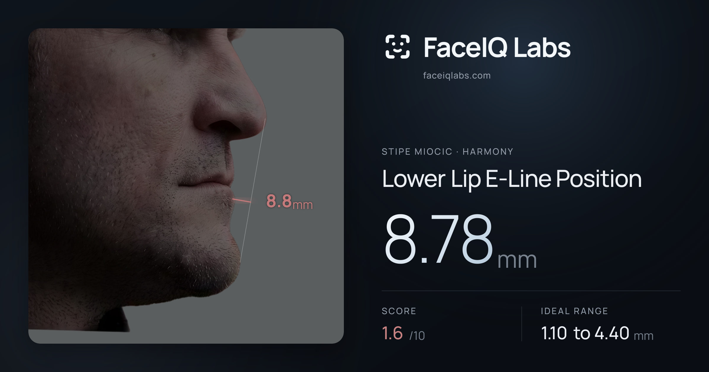 Stipe Miocic Lower Lip E-Line Position: 8.78mm, drawn on the photo