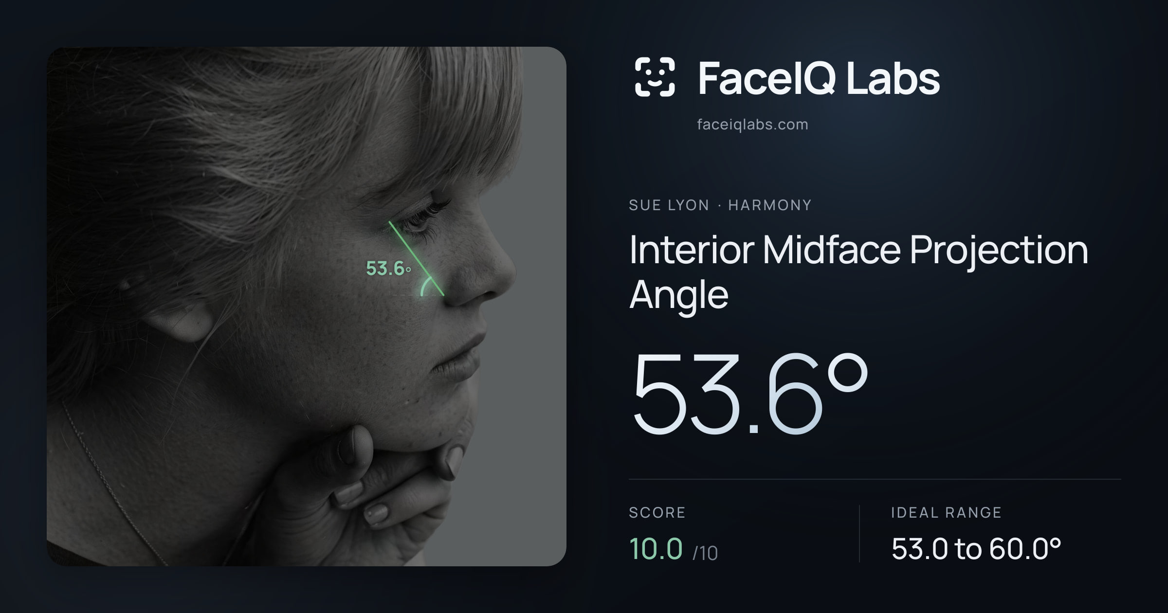 Sue Lyon Interior Midface Projection Angle: 53.6°, drawn on the photo