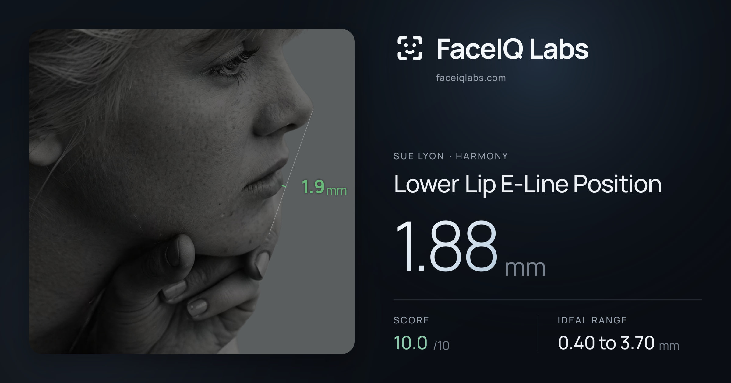 Sue Lyon Lower Lip E-Line Position: 1.88mm, drawn on the photo