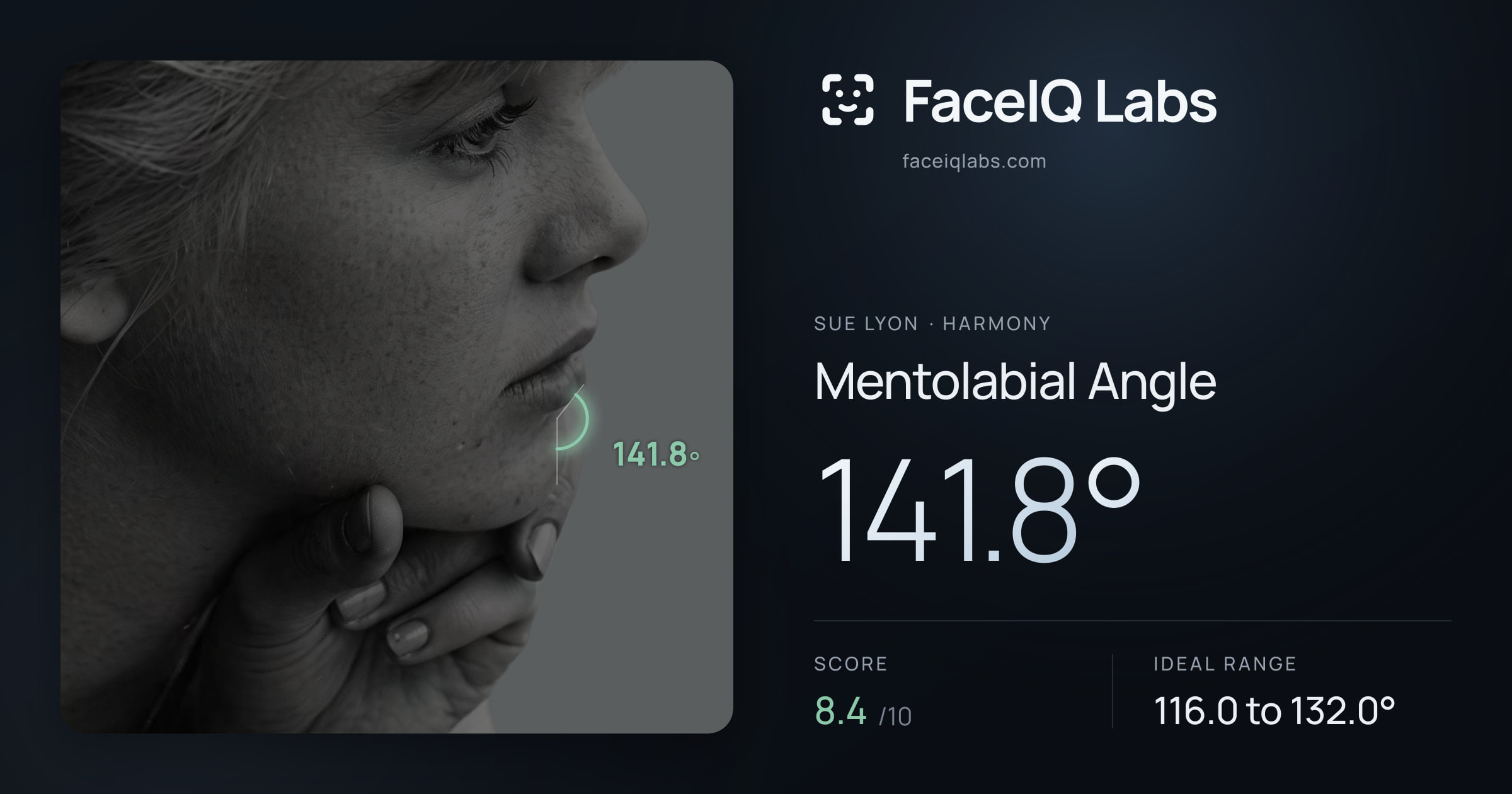 Sue Lyon Mentolabial Angle: 141.8°, drawn on the photo
