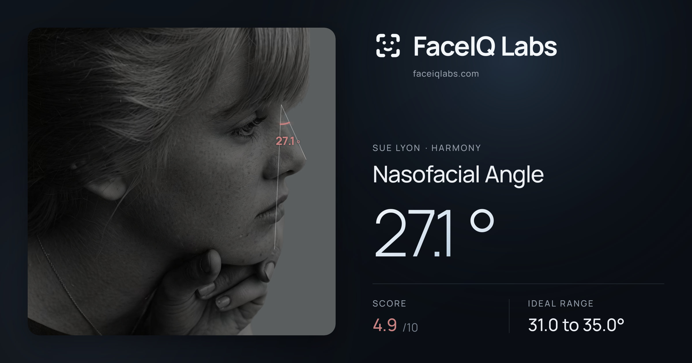 Sue Lyon Nasofacial Angle: 27.1°, drawn on the photo