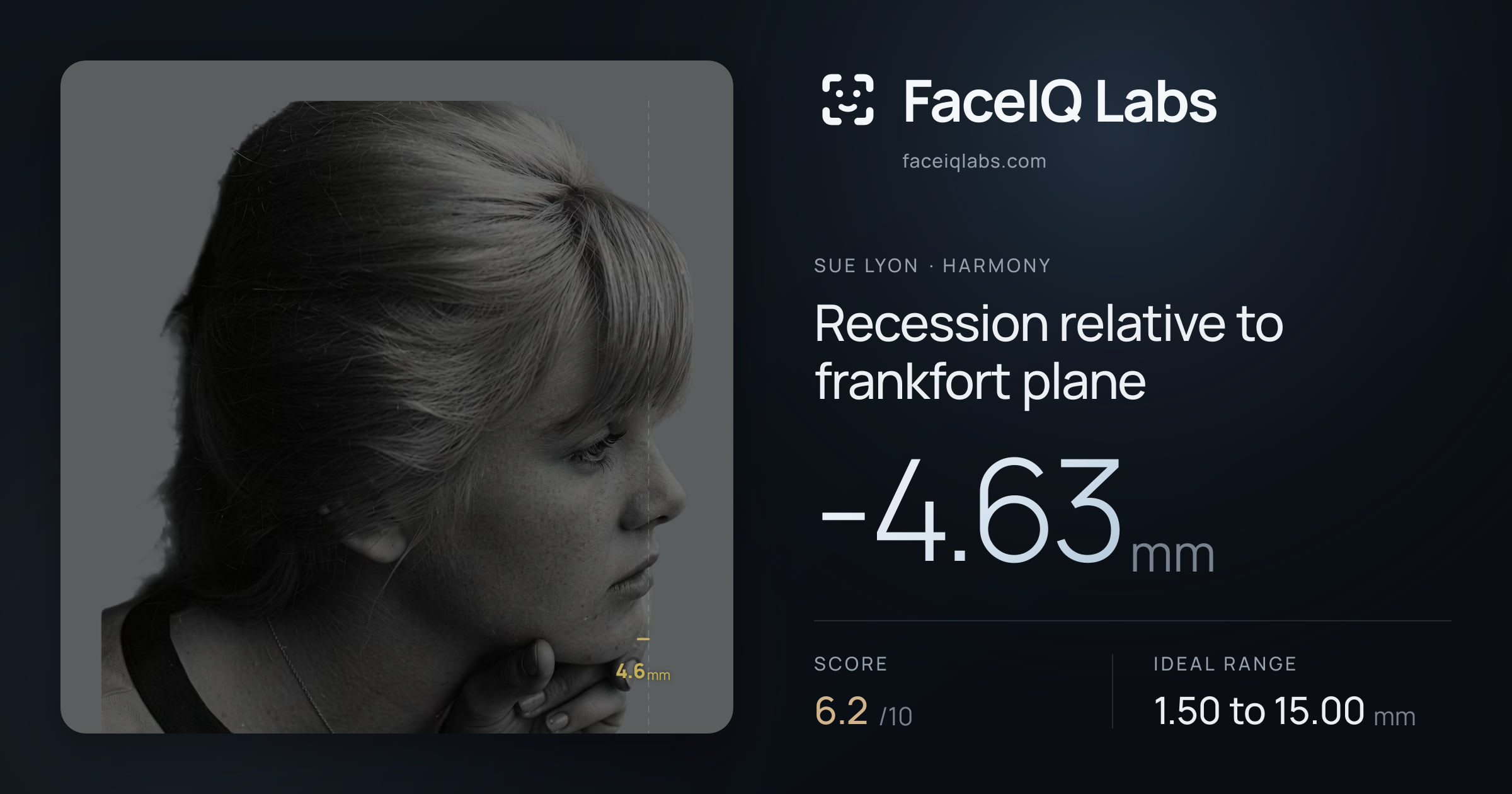 Sue Lyon Recession relative to frankfort plane: -4.63mm, drawn on the photo