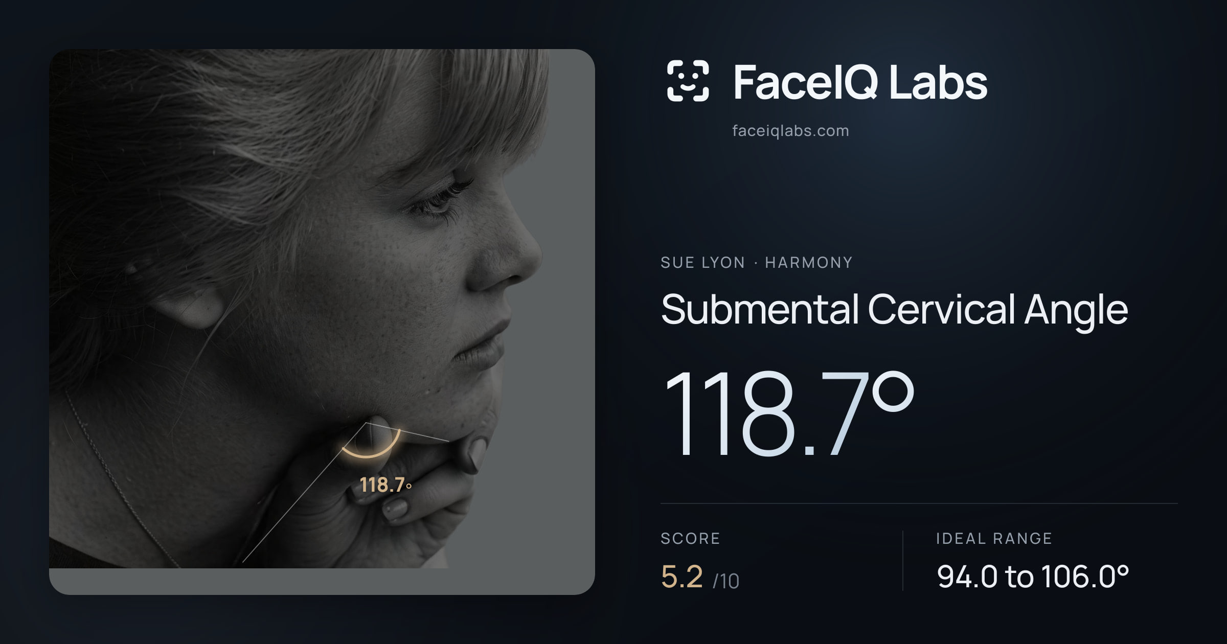 Sue Lyon Submental Cervical Angle: 118.7°, drawn on the photo