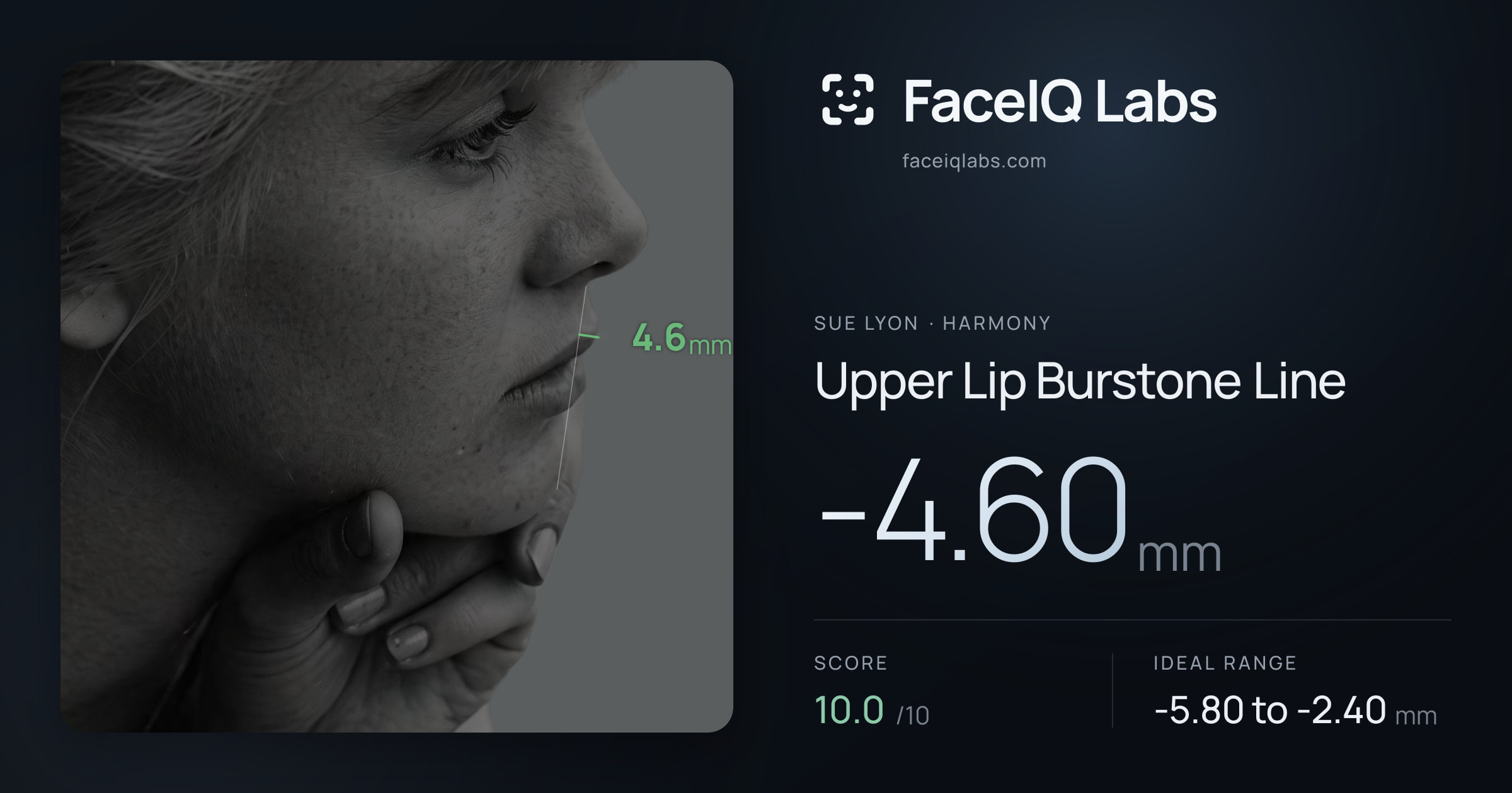 Sue Lyon Upper Lip Burstone Line: -4.60mm, drawn on the photo