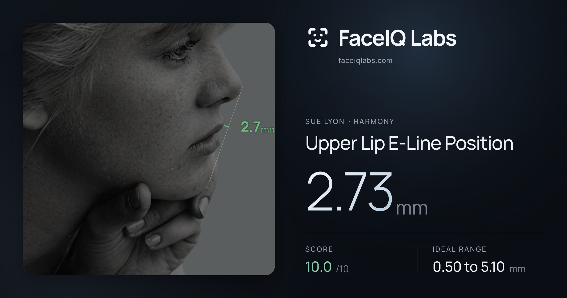 Sue Lyon Upper Lip E-Line Position: 2.73mm, drawn on the photo