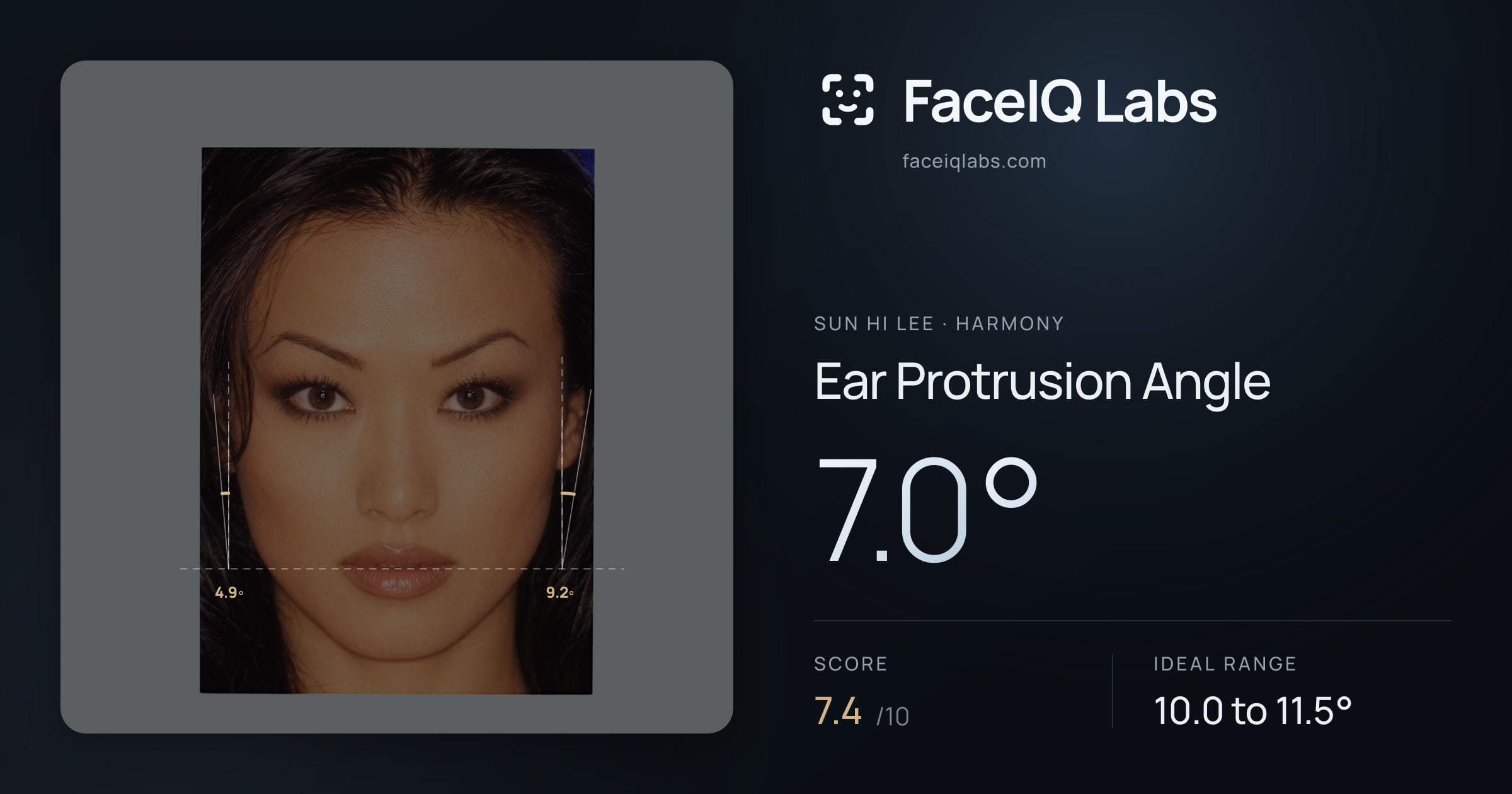 Sun Hi Lee Ear Protrusion Angle: 7.0°, drawn on the photo