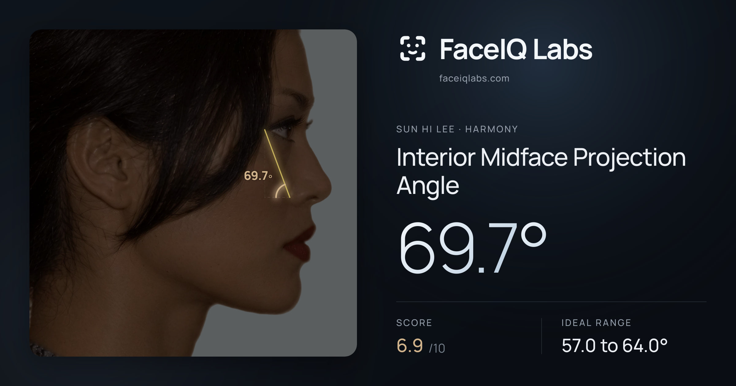 Sun Hi Lee Interior Midface Projection Angle: 69.7°, drawn on the photo
