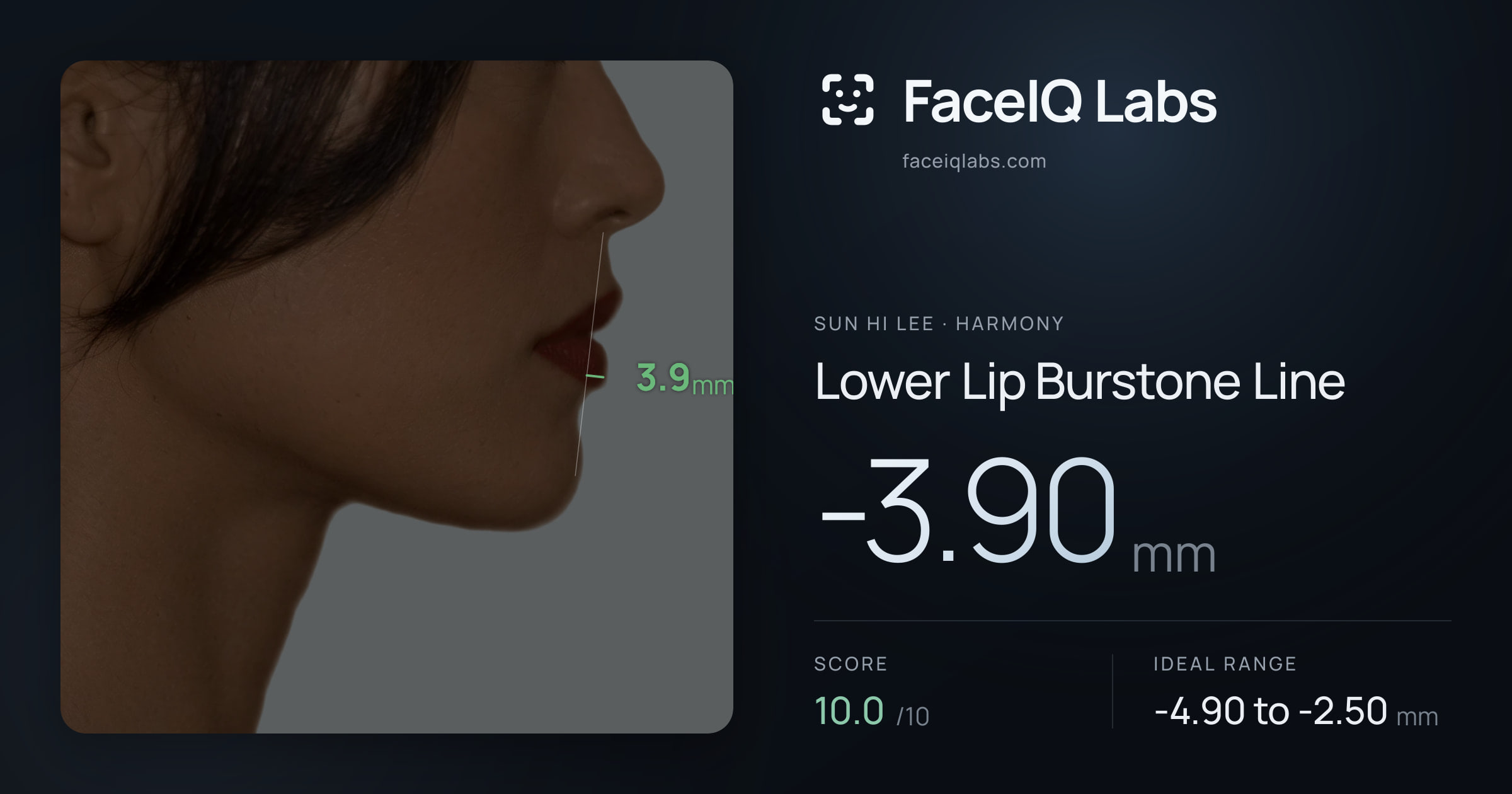 Sun Hi Lee Lower Lip Burstone Line: -3.90mm, drawn on the photo
