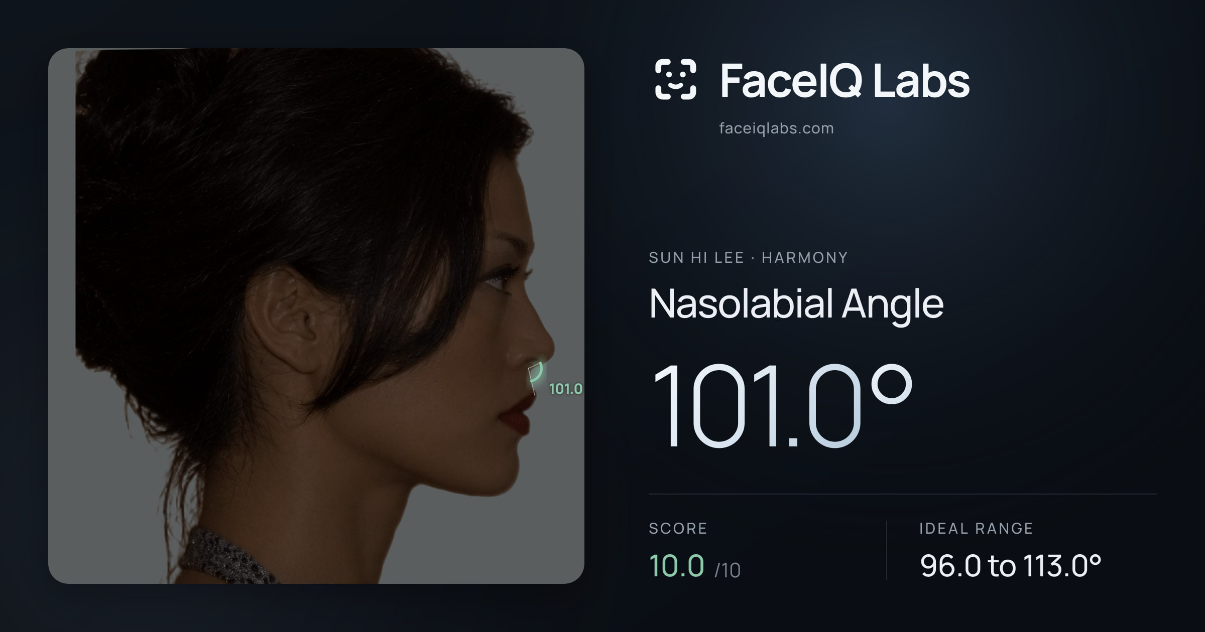 Sun Hi Lee Nasolabial Angle: 101.0°, drawn on the photo