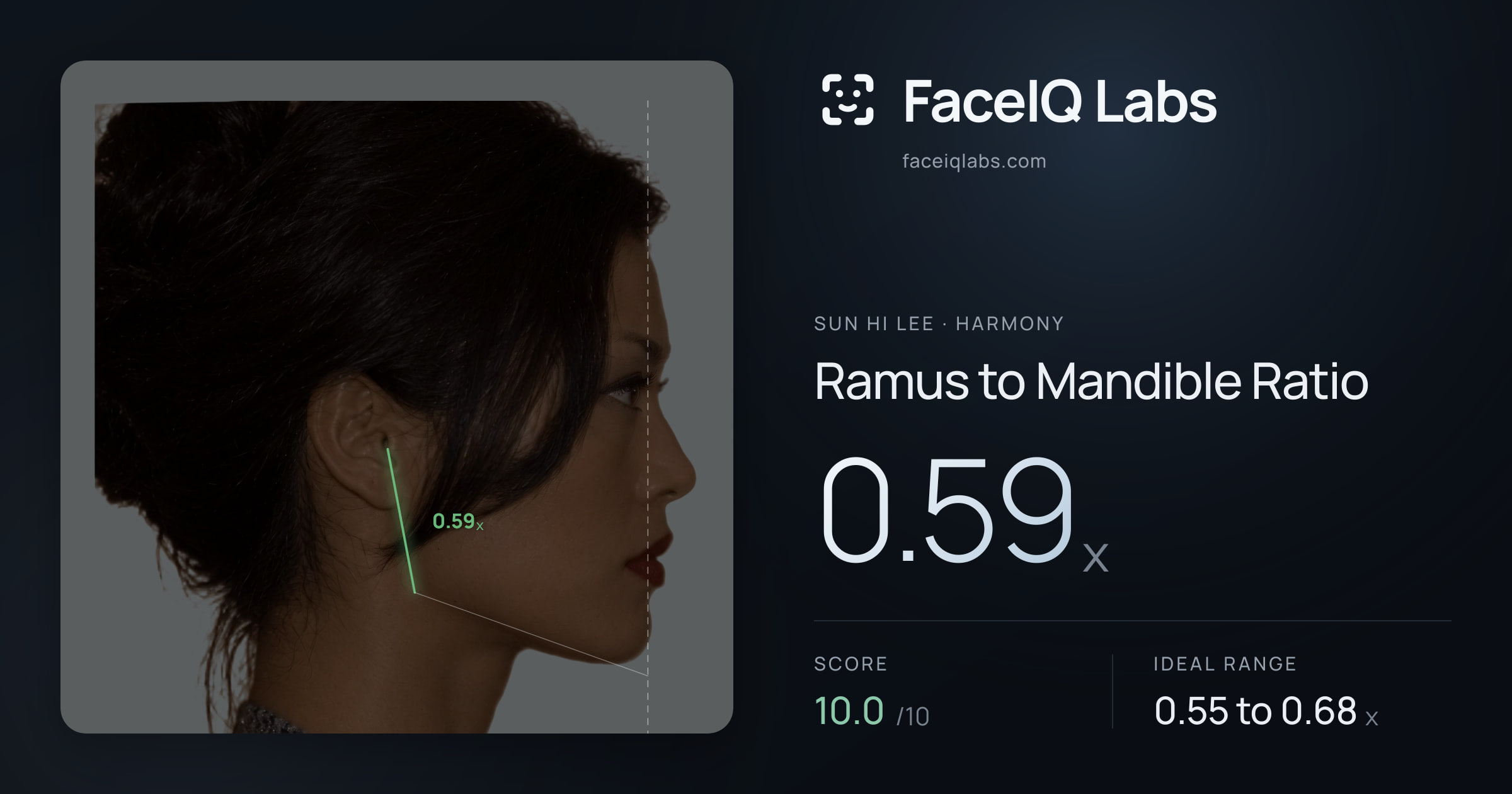 Sun Hi Lee Ramus to Mandible Ratio: 0.59x, drawn on the photo