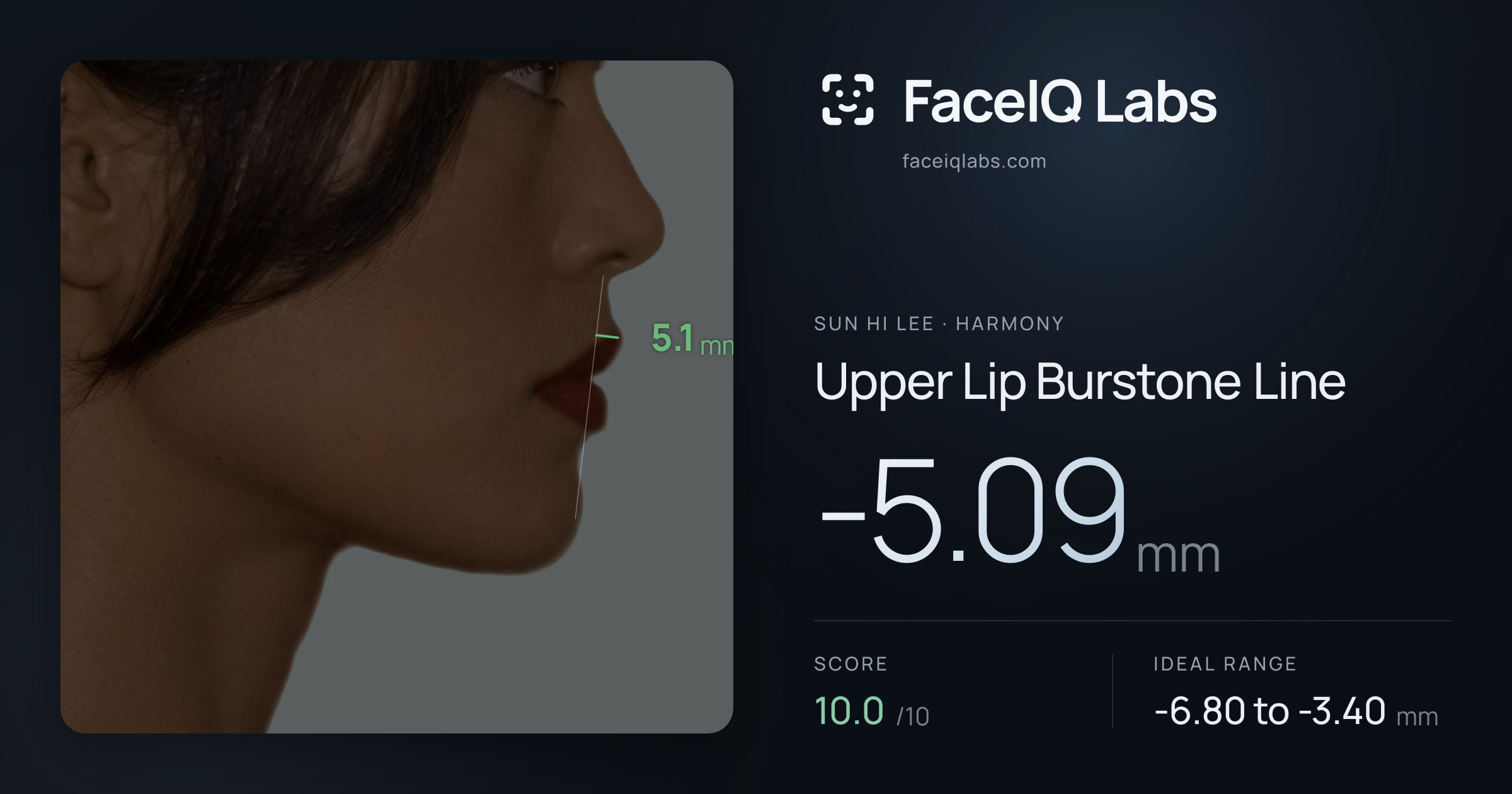 Sun Hi Lee Upper Lip Burstone Line: -5.09mm, drawn on the photo