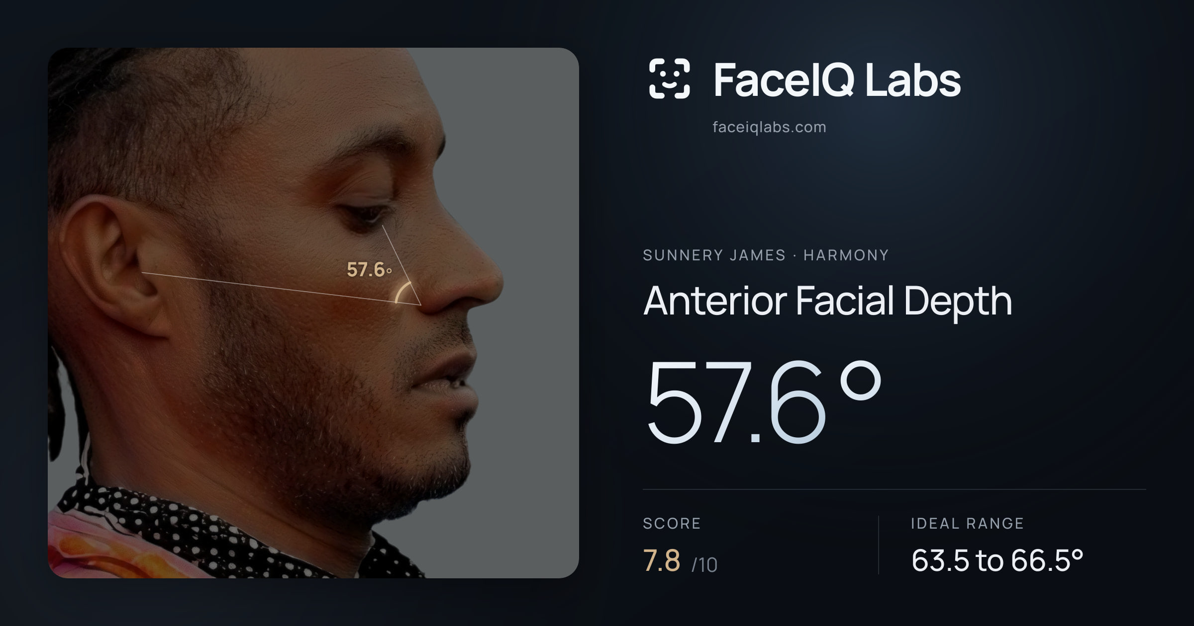 Sunnery James Anterior Facial Depth: 57.6°, drawn on the photo