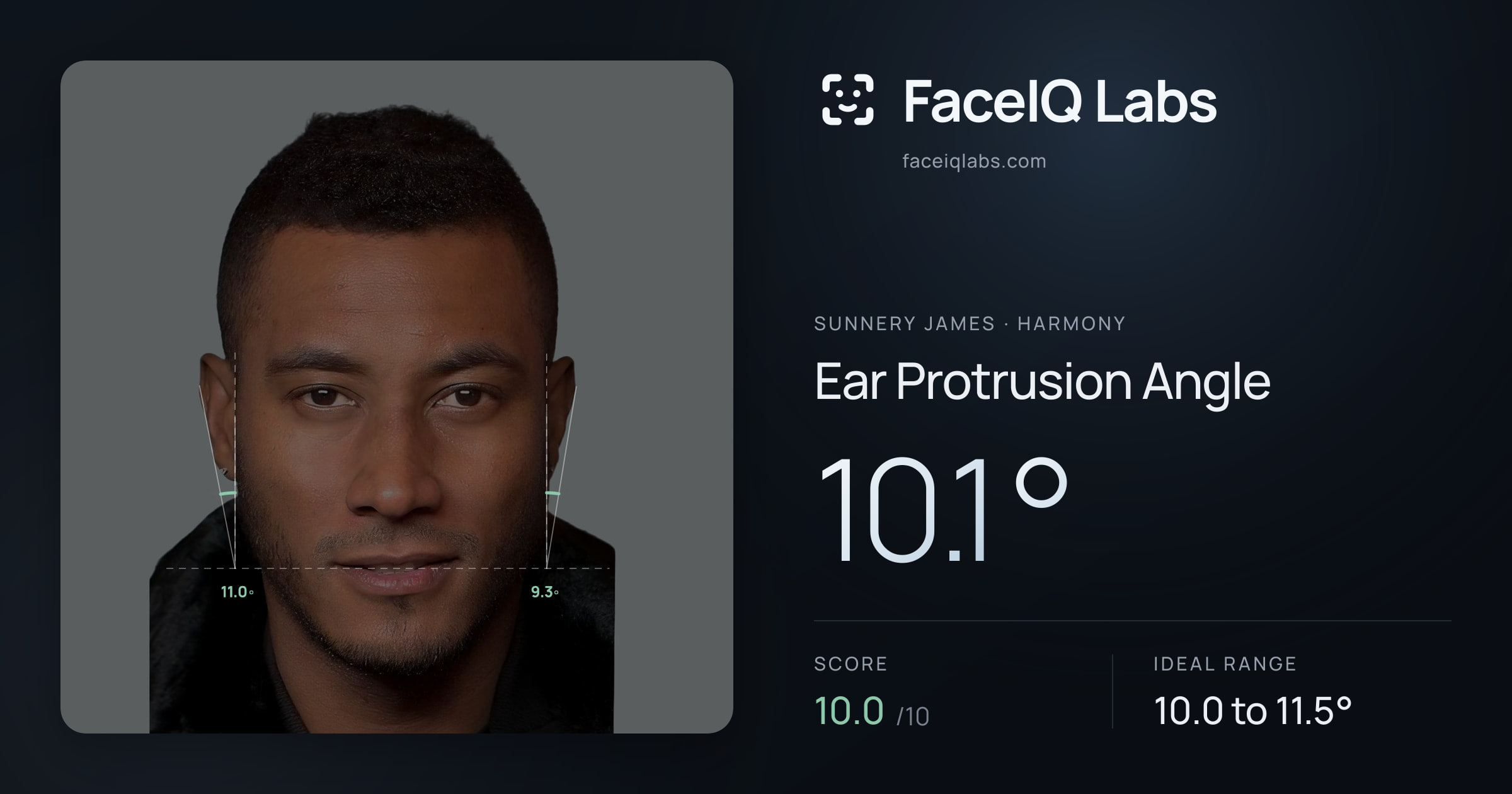 Sunnery James Ear Protrusion Angle: 10.1°, drawn on the photo
